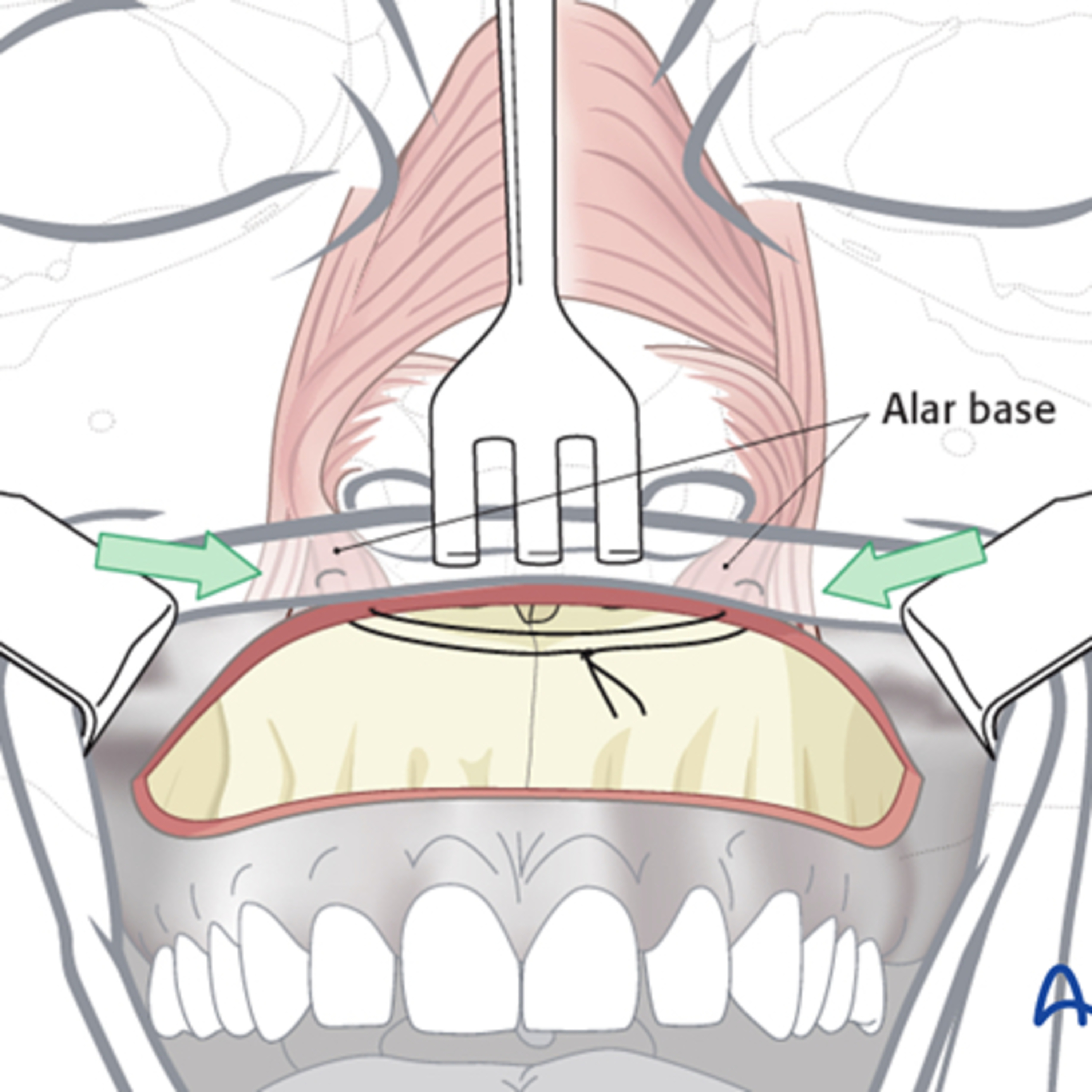 “What is the Alar Cinch Technique to Prevent Nasal Base Widening During Orthognathic Surgery?” episode artwork