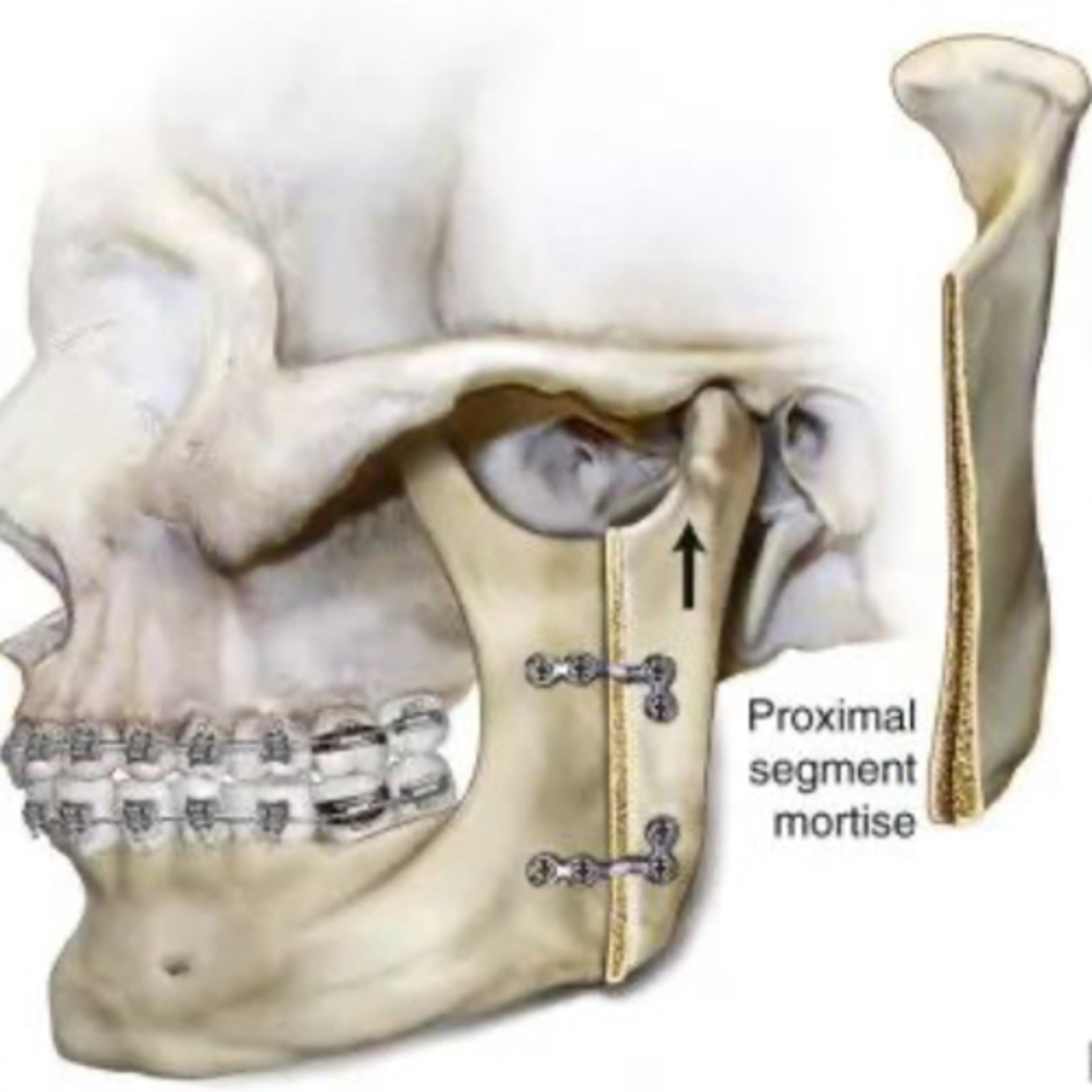 "What are the Indications, Pros, Cons of IVRO Surgery on the Mandible?" episode artwork