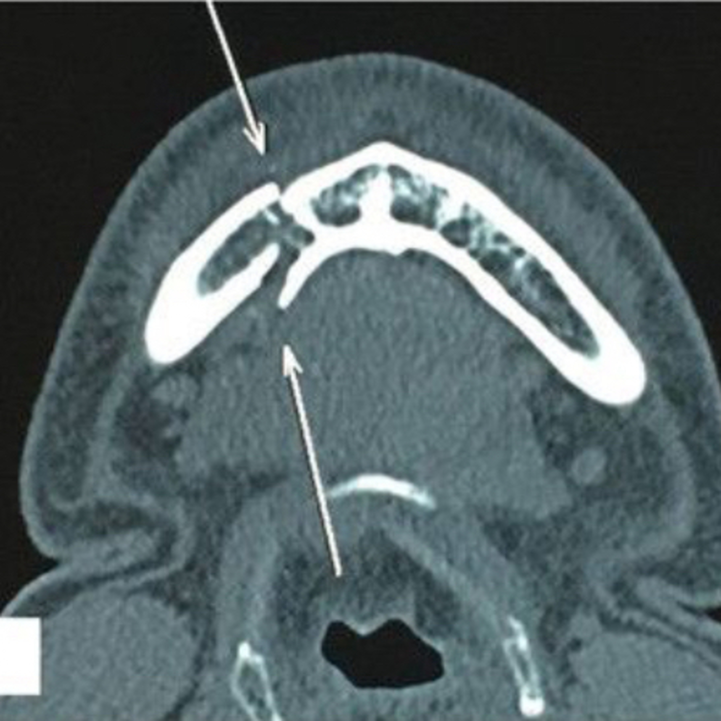 “How To Prevent Splaying of the Lingual Cortex During Surgical Repair of a Symphysis Fracture?” episode artwork