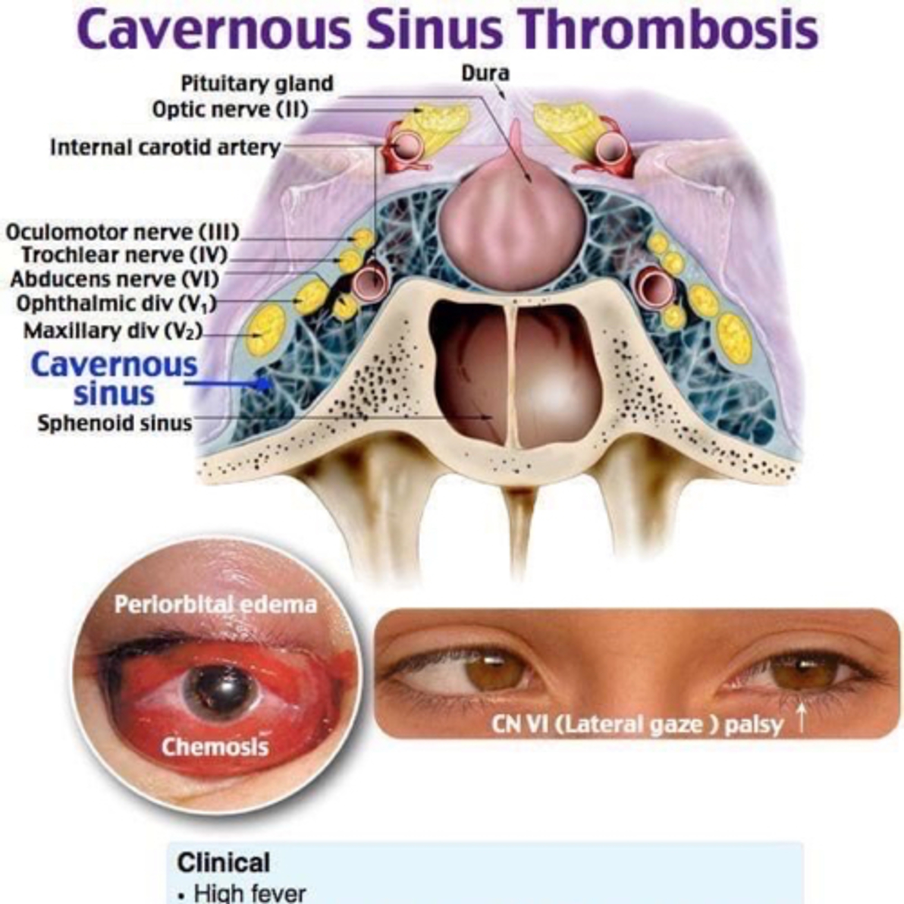 “What Important Structures Are Affected In Cavernous Sinus Thrombosis?” episode artwork