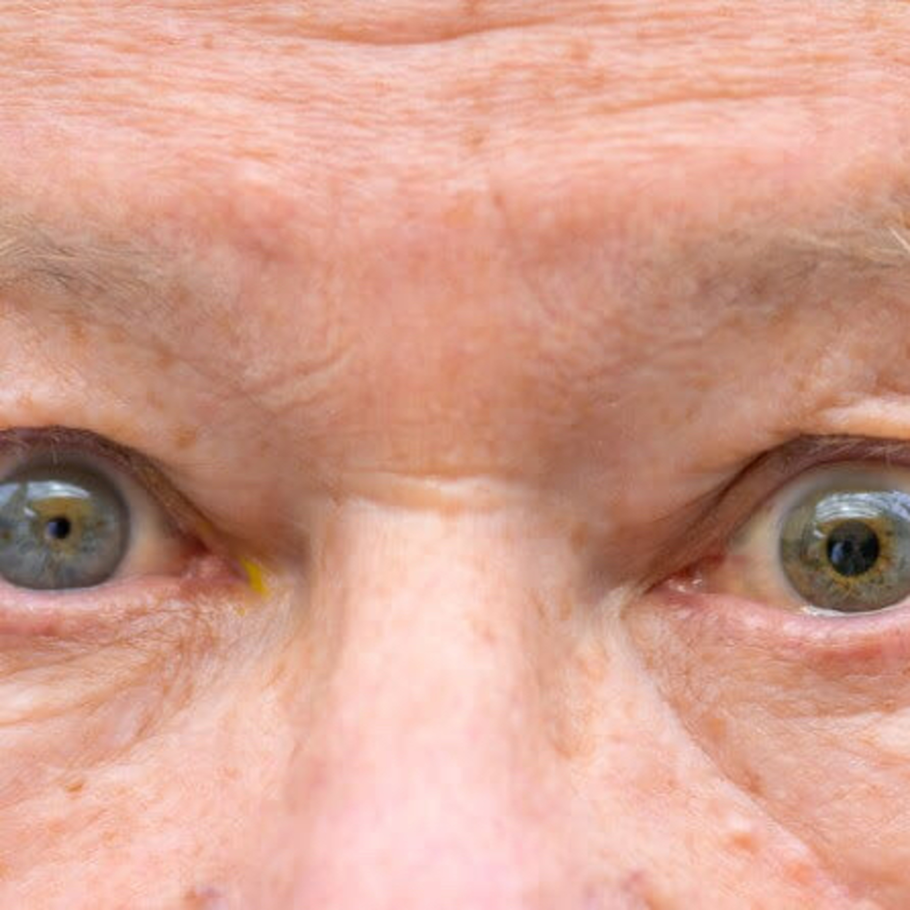 “What is Marcus Gunn Pupil and What Does it Indicate?” episode artwork