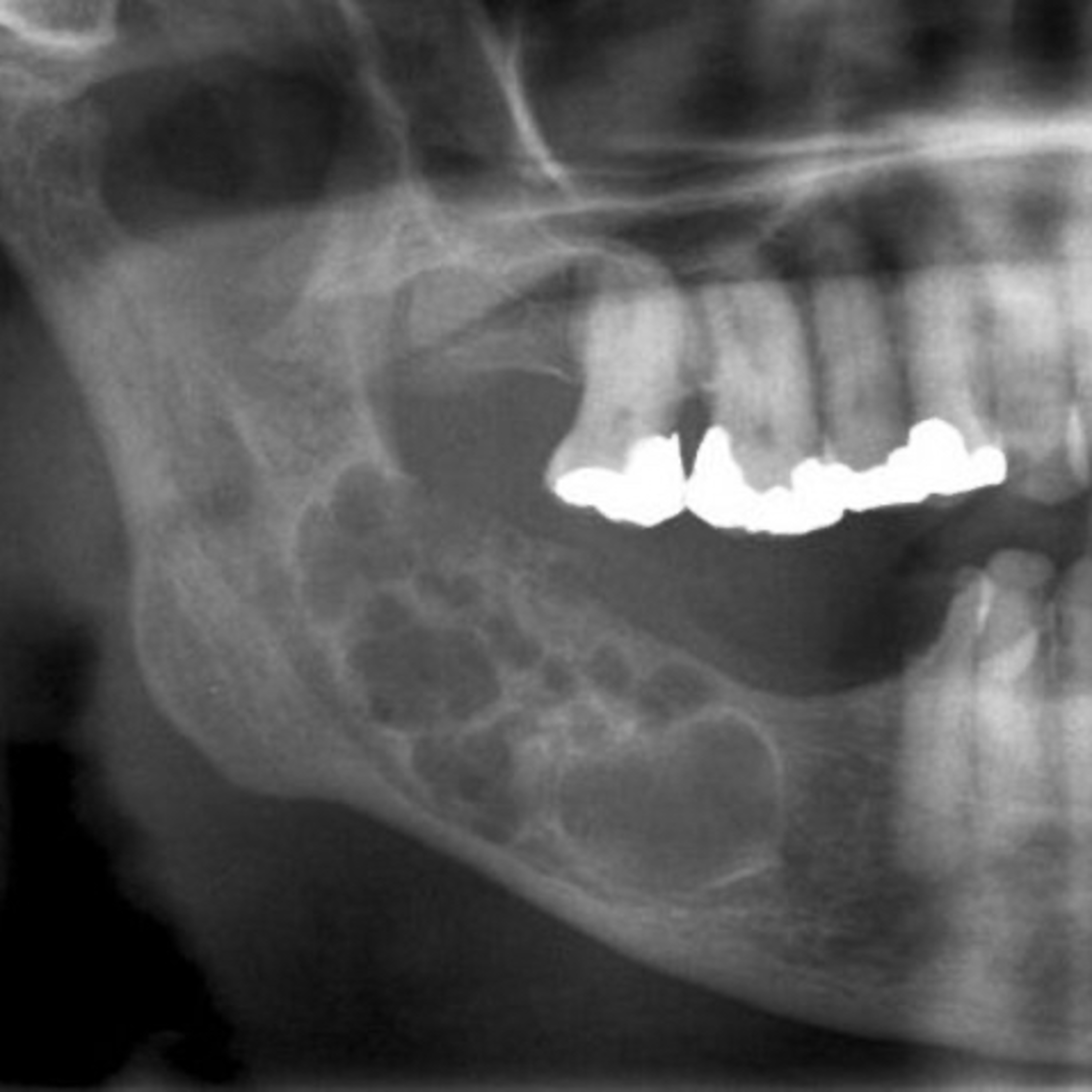 “What are the 6 Subtypes of Conventional (Solid or Multicystic) Ameloblastoma?” episode artwork