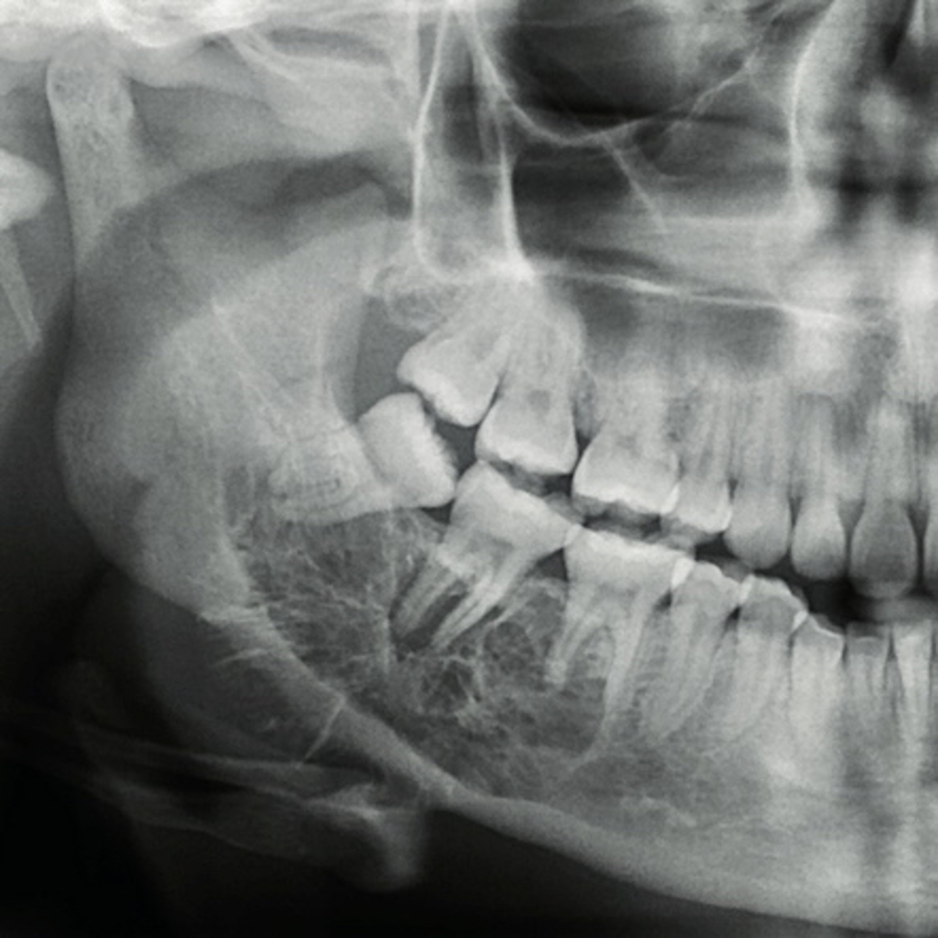 “What are the Key Radiographic Features of the Odontogenic Myxoma?” episode artwork