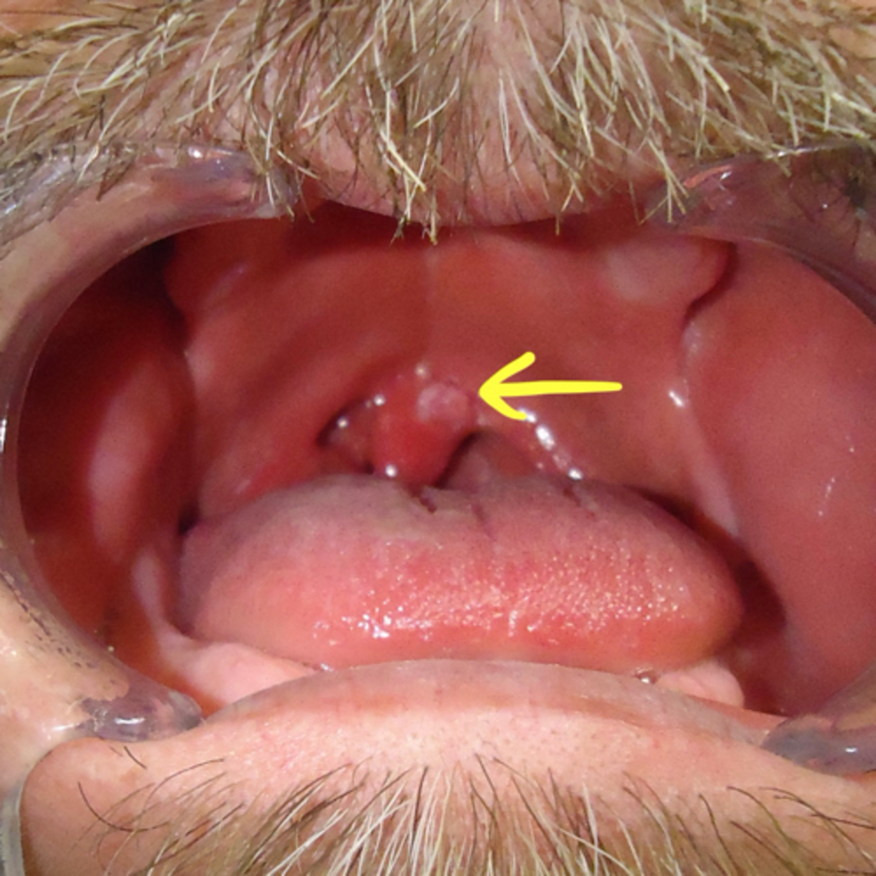 “What Are Key Features of Oral Squamous Papillomas?” episode artwork
