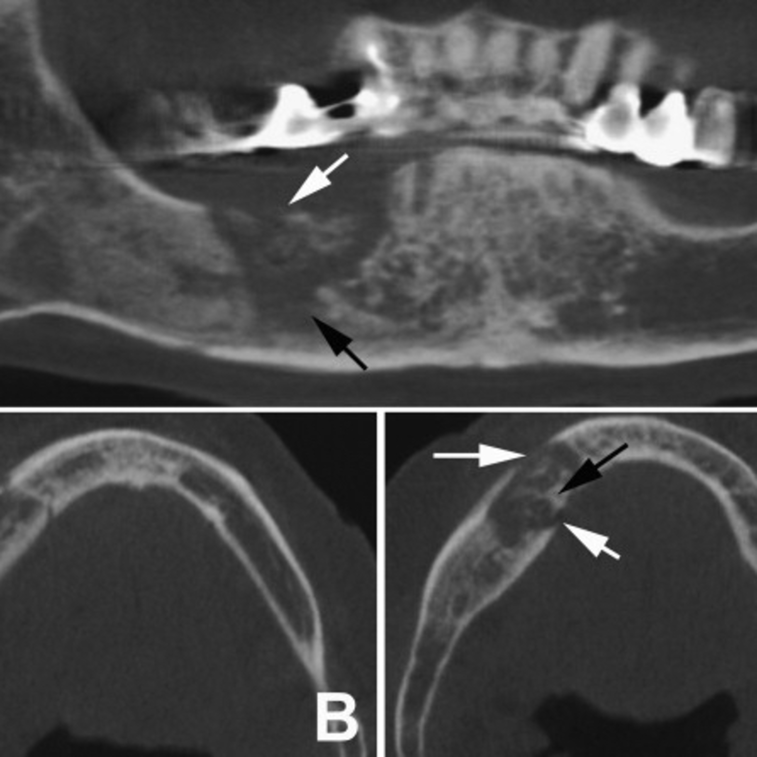“What Are Common Signs Of Osteomyelitis & Osteonecrosis of the Maxilla