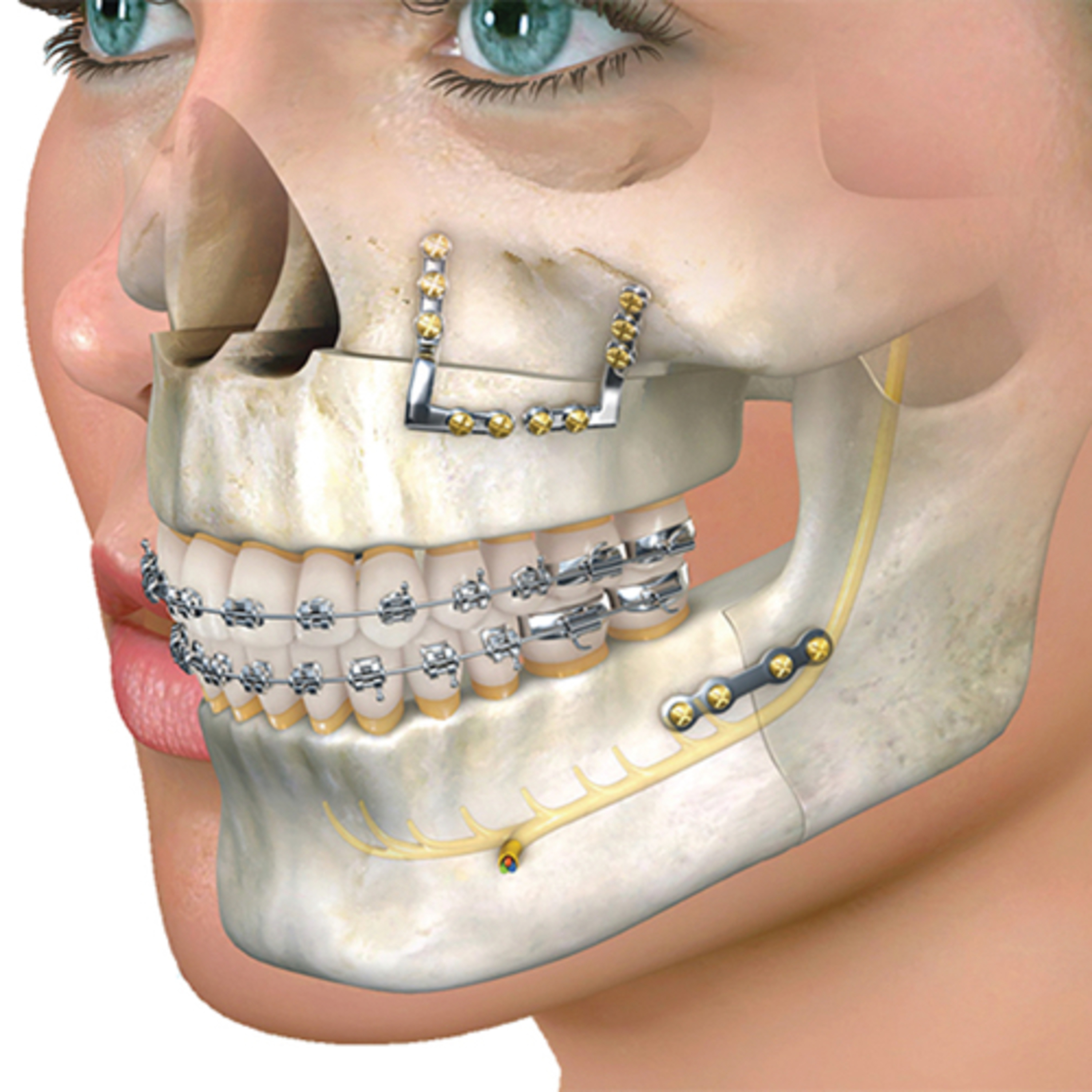 “What is Bimaxillary Surgery and Which Deformities Can It Correct?”  episode artwork