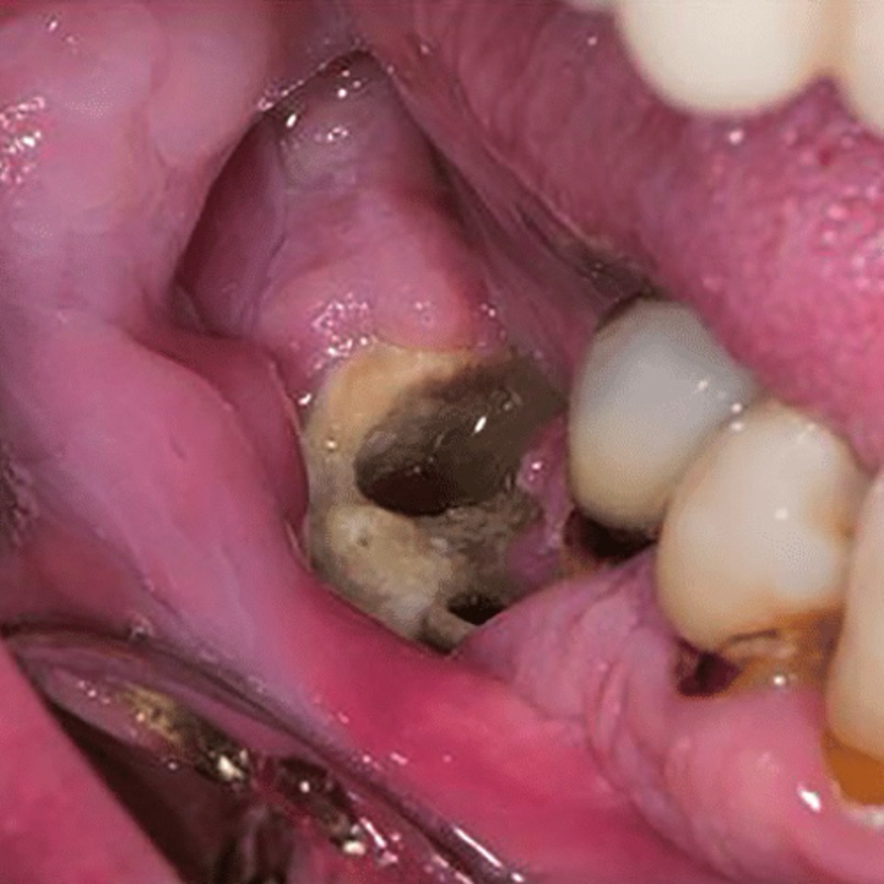 “What are the Stages of MRONJ?
(Medication-Related Osteonecrosis of the Jaw)” episode artwork