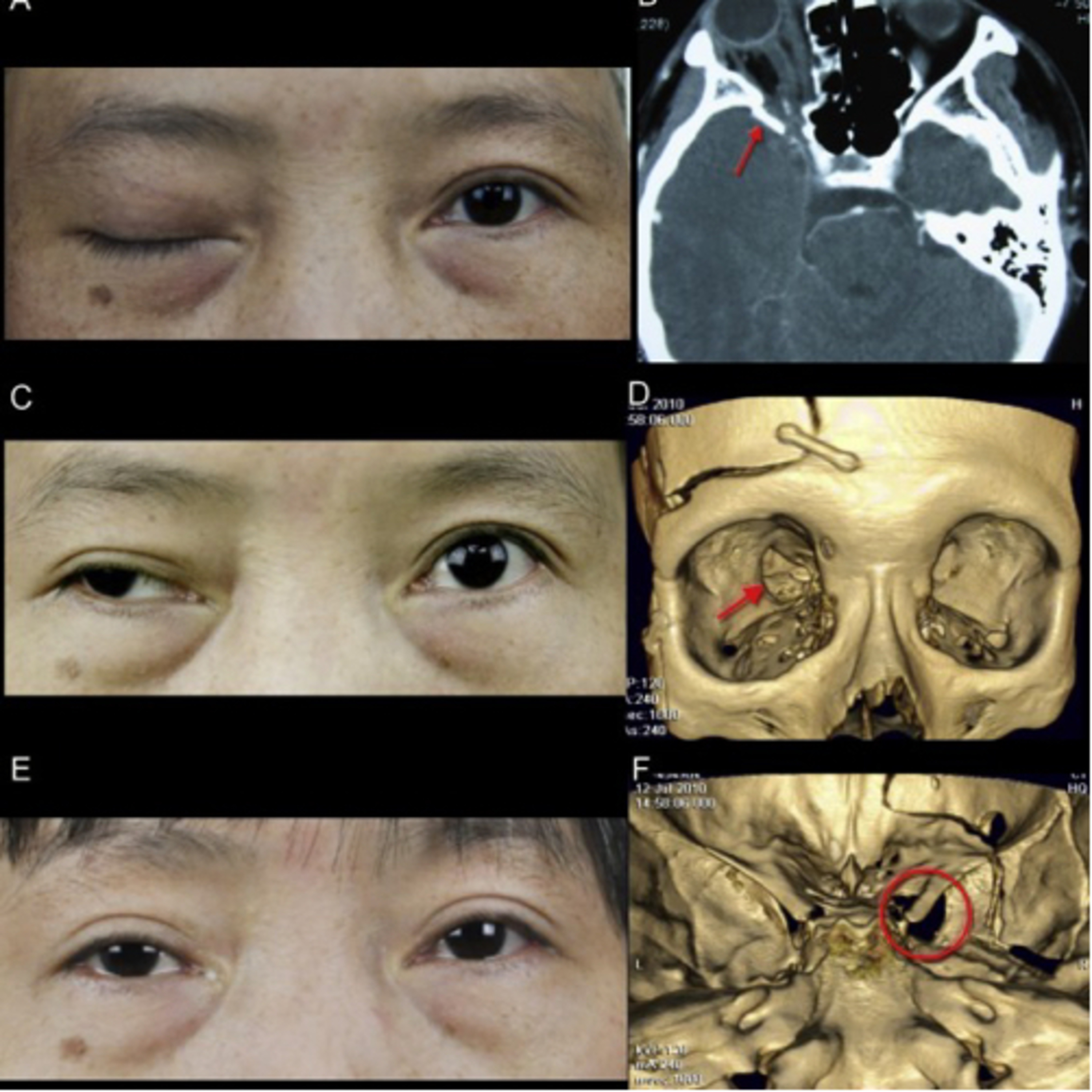 “What Are Key Differences Between Superior Orbital Fissure Syndrome and Orbital Apex Syndrome?” episode artwork