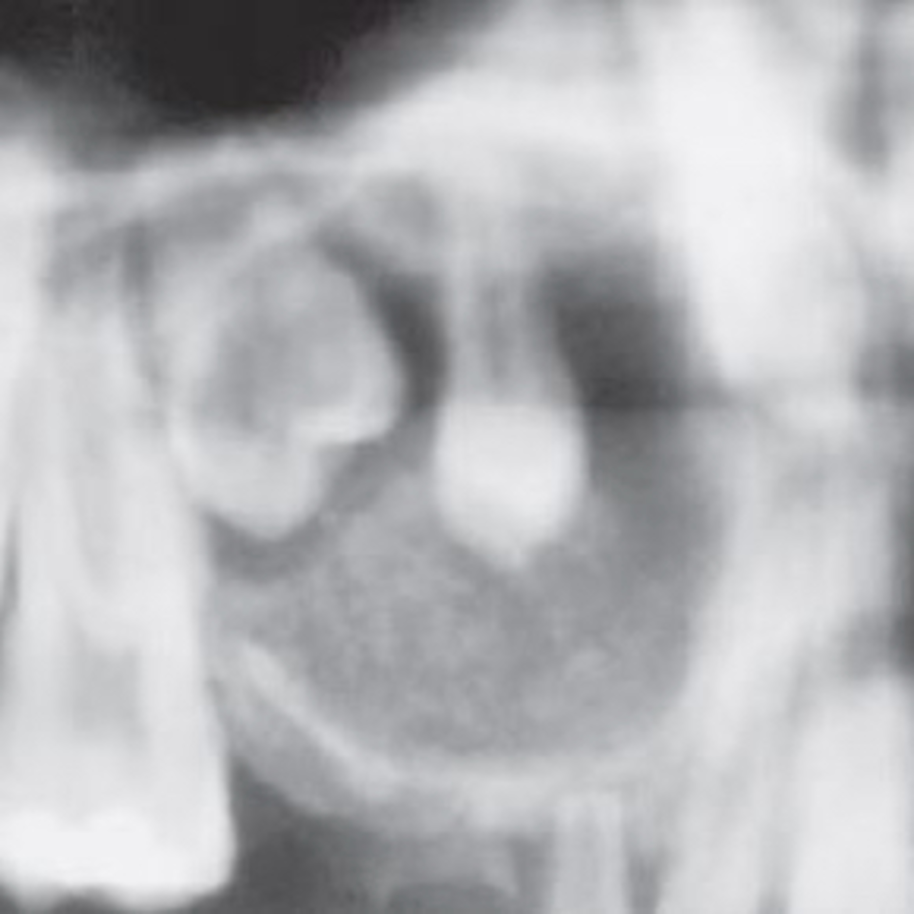 “Why is the Adenomatoid Odontogenic Tumor known as the ‘Tumor of 2/3’s’?” episode artwork
