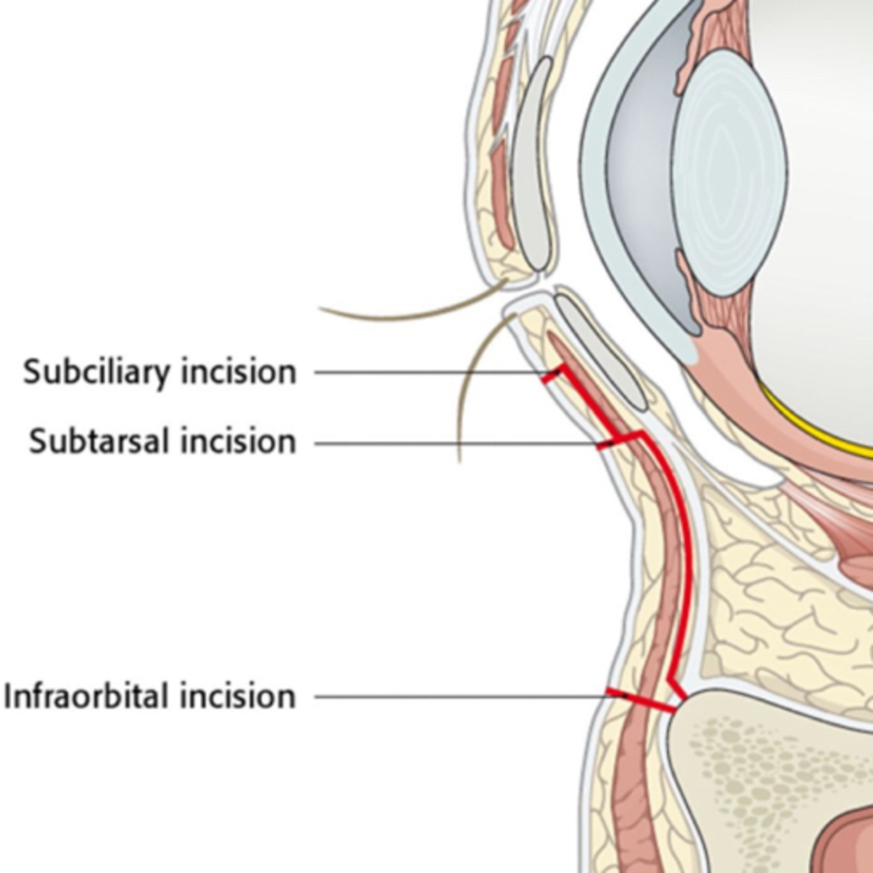 “Differences Between The Subciliary, Subtarsal and Infraorbital Incisions When Approaching The Orbit episode artwork