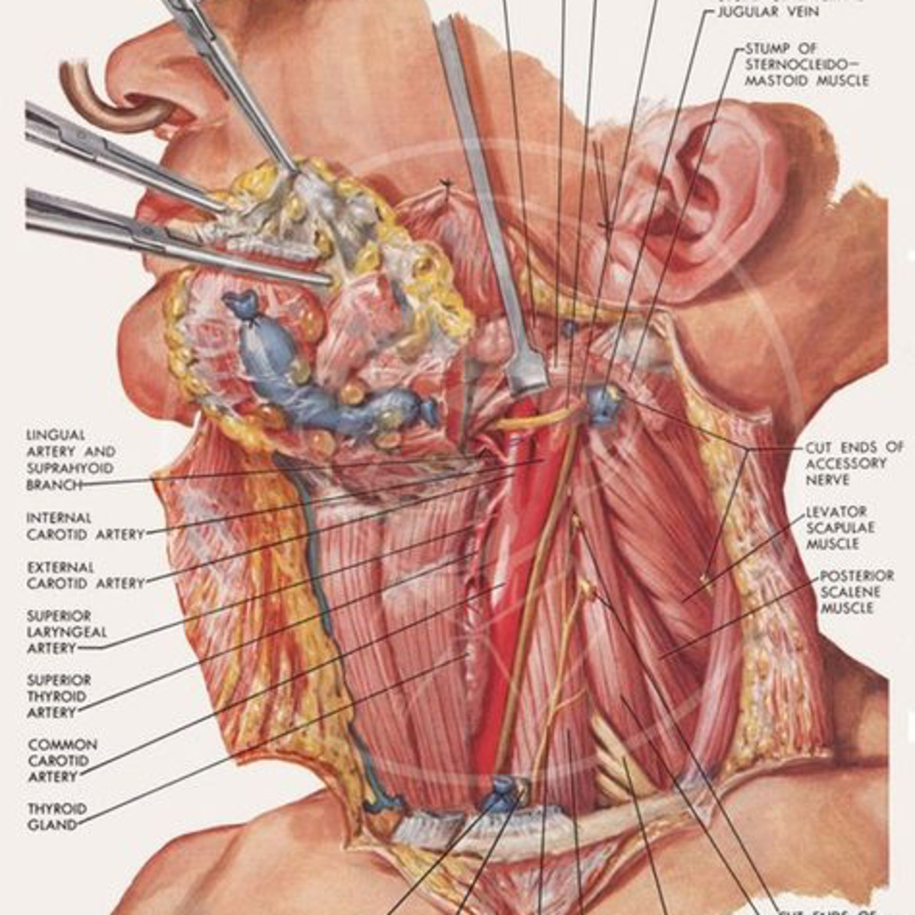 “What Is A Supraomohyoid Selective Neck Dissection?” episode artwork