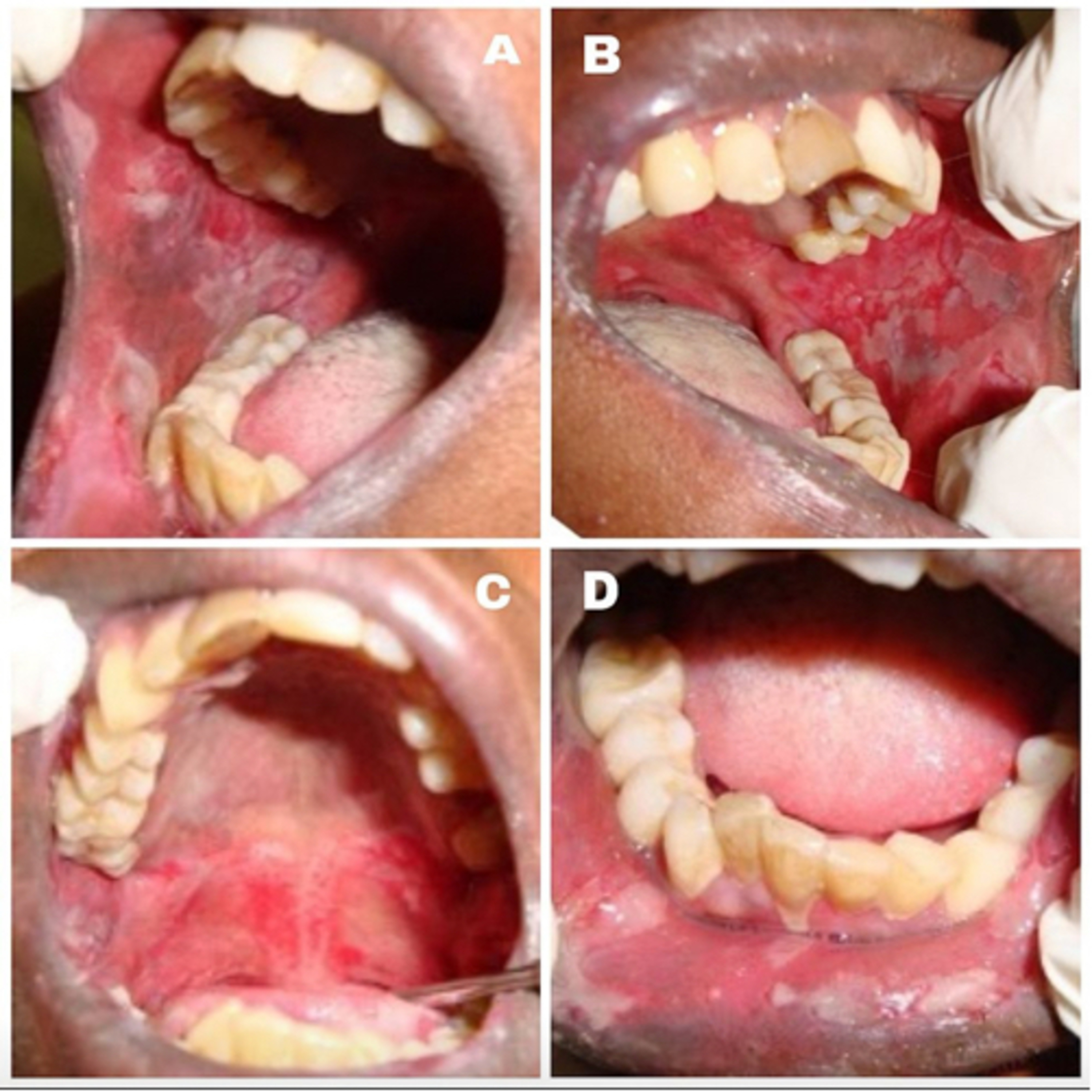 “What Are Key Differences Between Pemphigus Vulgaris & Mucous Membrane Pemphigoid?” episode artwork