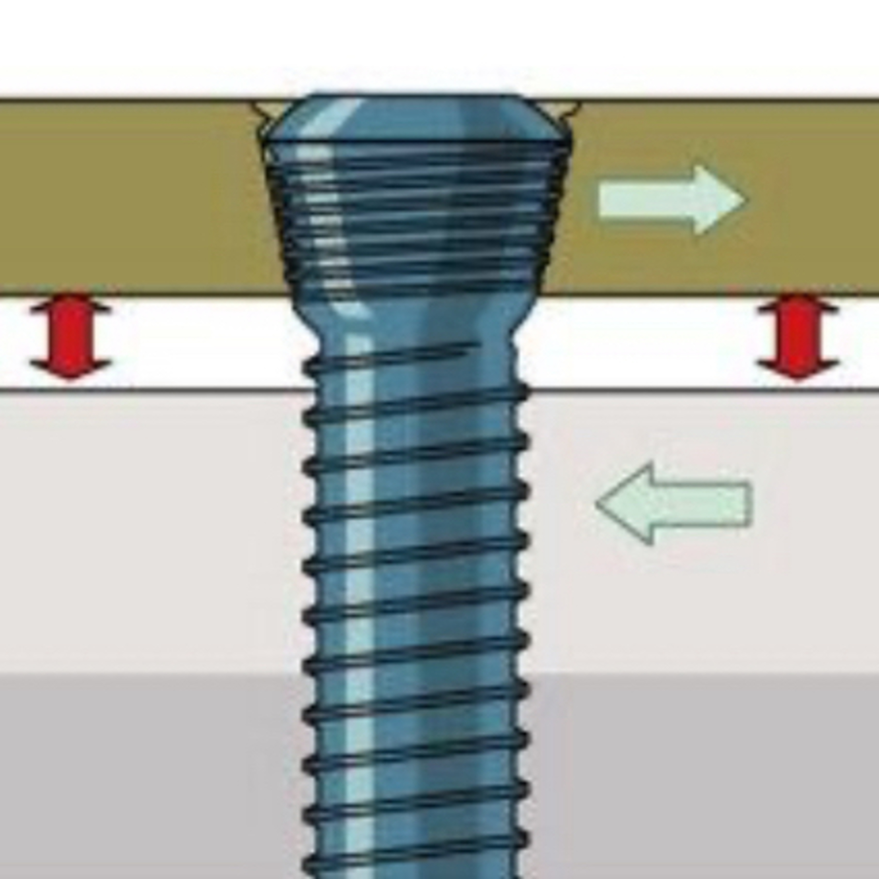 “What Differentiates ‘Locking’ vs. ‘Non-Locking’ Bone Screws For Fracture Repairs?” episode artwork