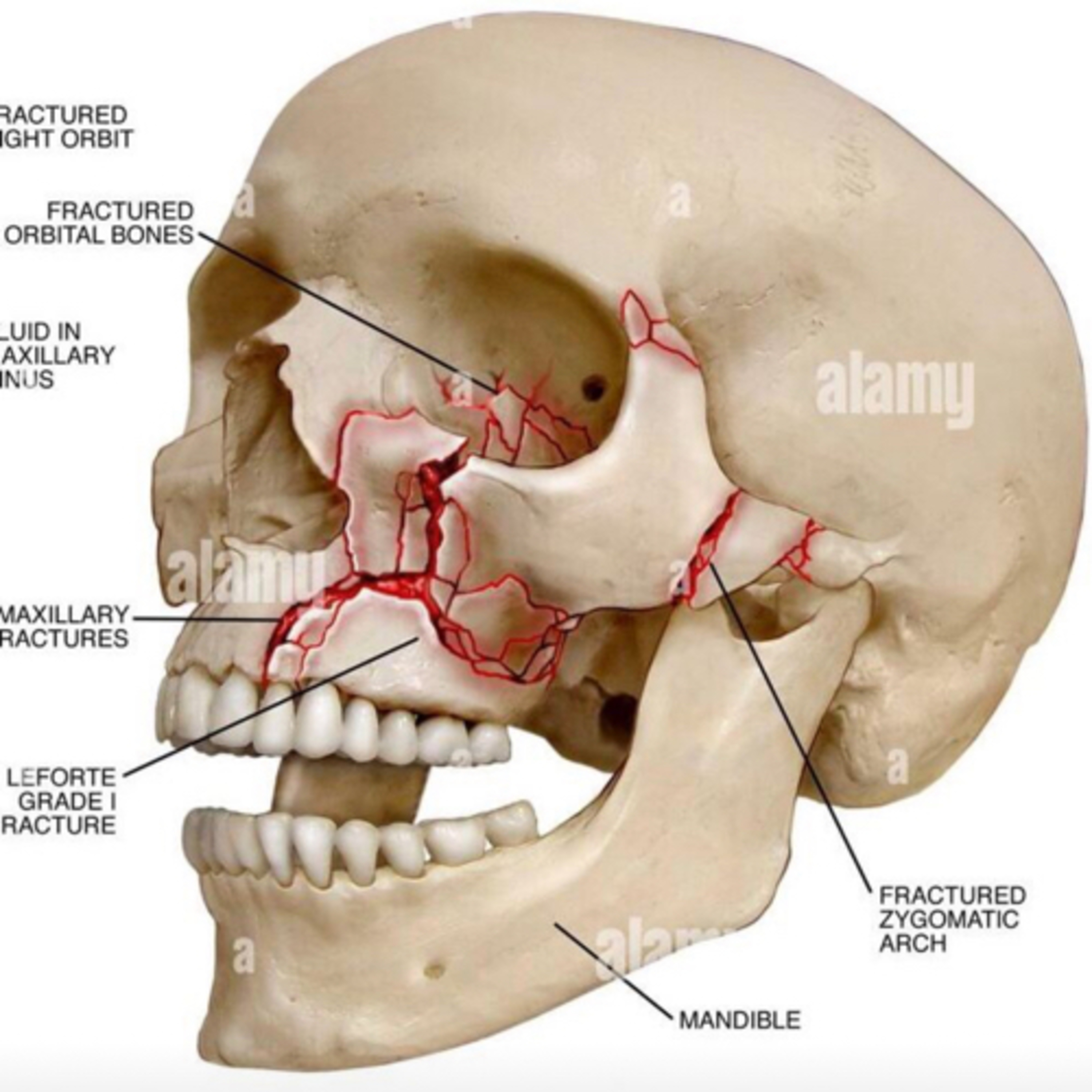 “What Are The 5 Most Common Facial Bone Fractures, In Order?” episode artwork