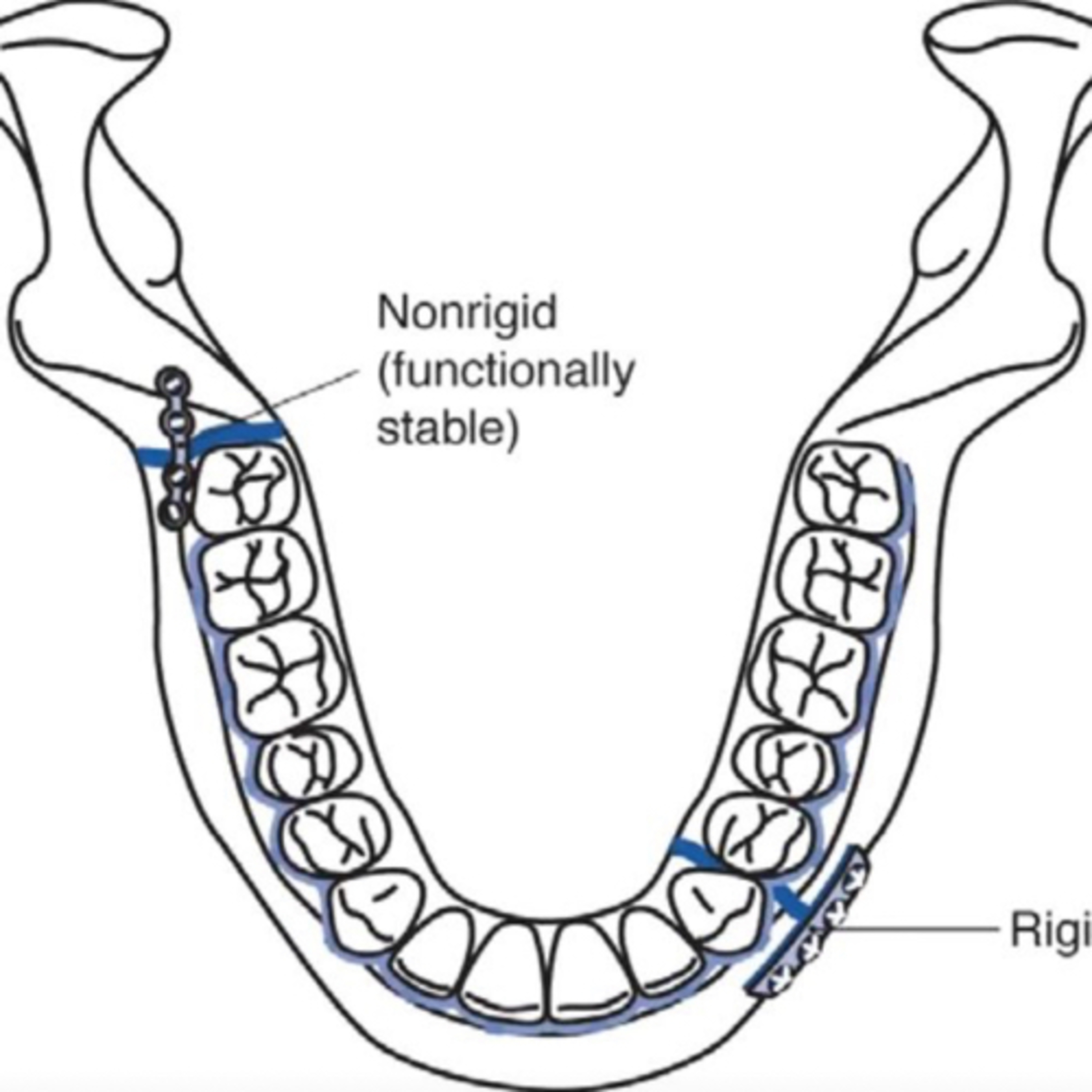 “What Is ‘Rigid’ vs. ‘Non-Rigid’ Fixation?” episode artwork