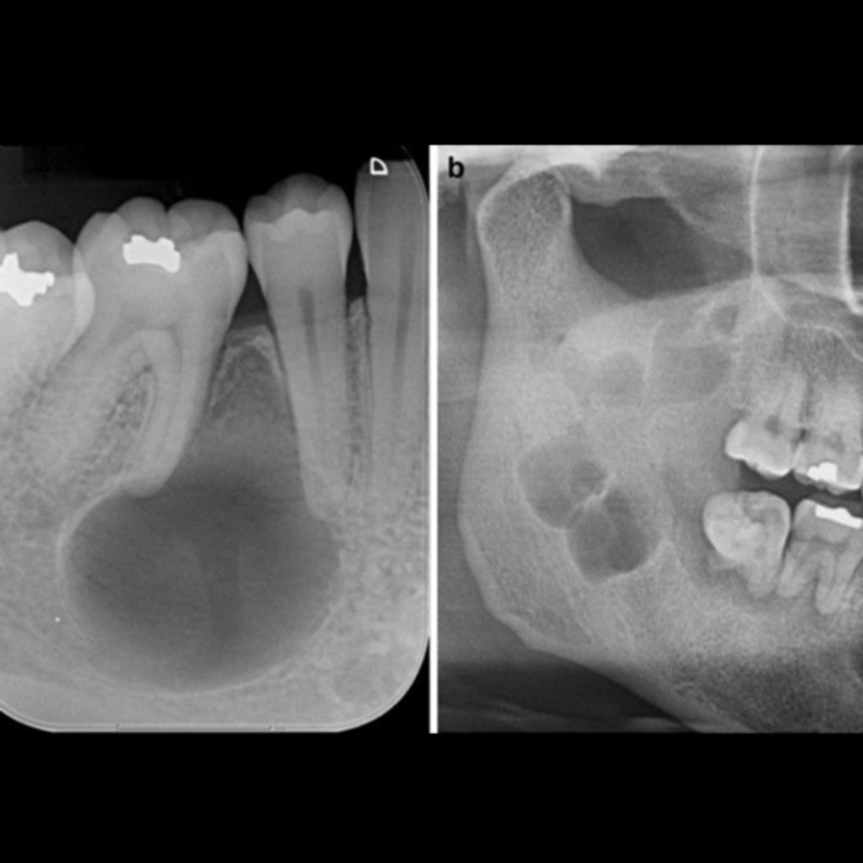 “What Are The Differences Between An Ameloblastoma & An Odontogenic Keratocyst?” episode artwork