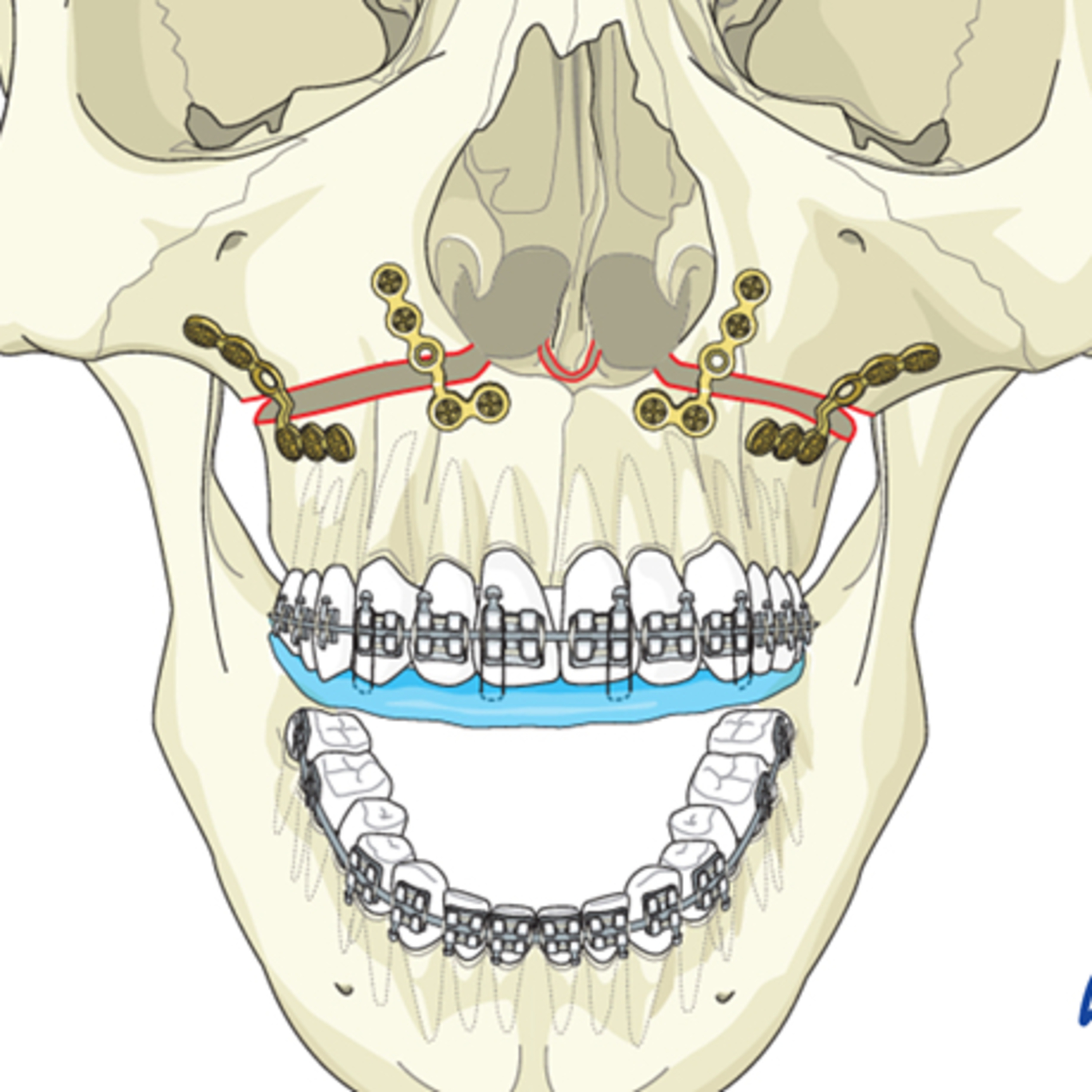 “What are Important Landmarks in the LeFort 1 Osteotomy of Orthognathic Surgery?” episode artwork