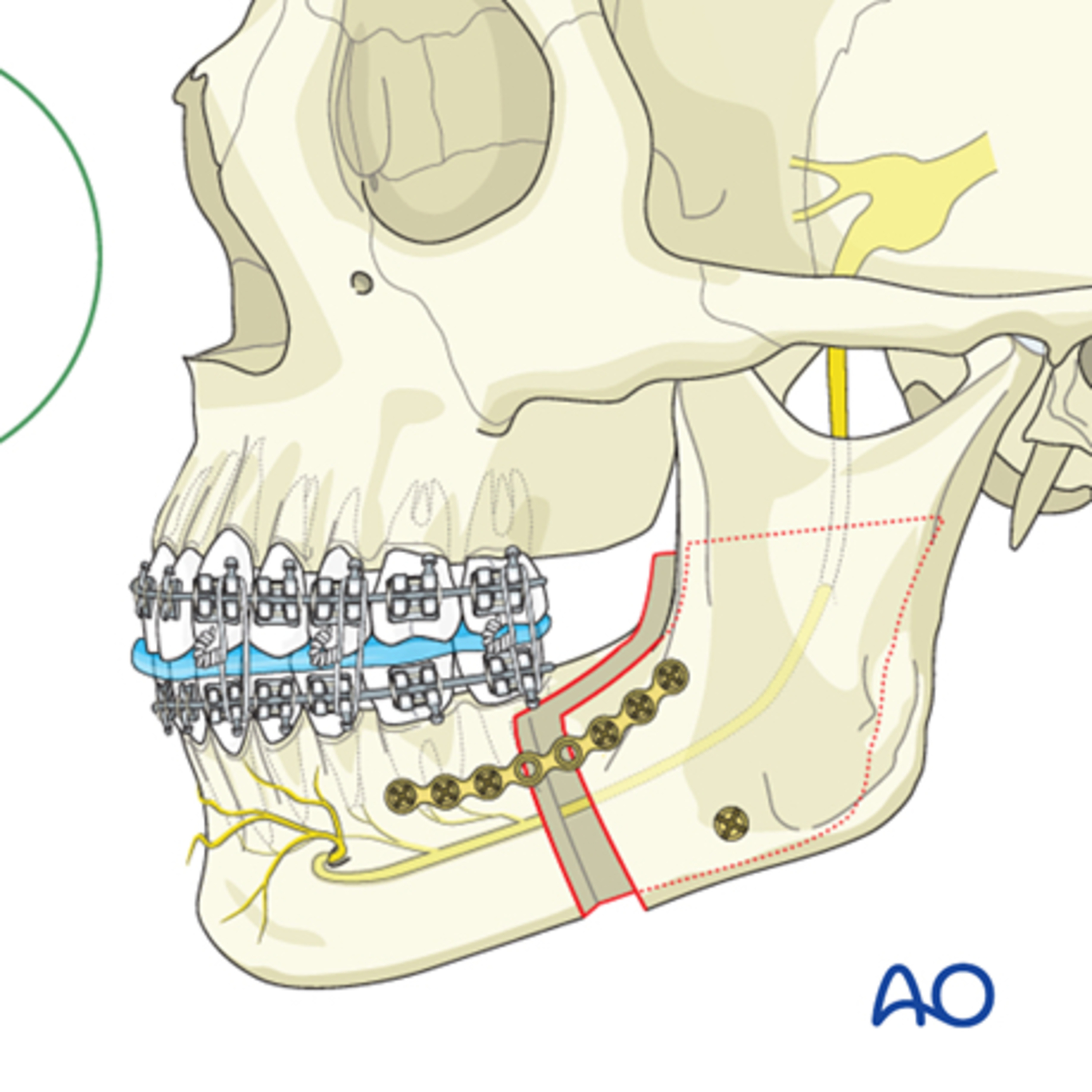 “What are Important Landmarks in the Bilateral Sagittal Split Osteotomy of Orthognathic Surgery?” episode artwork