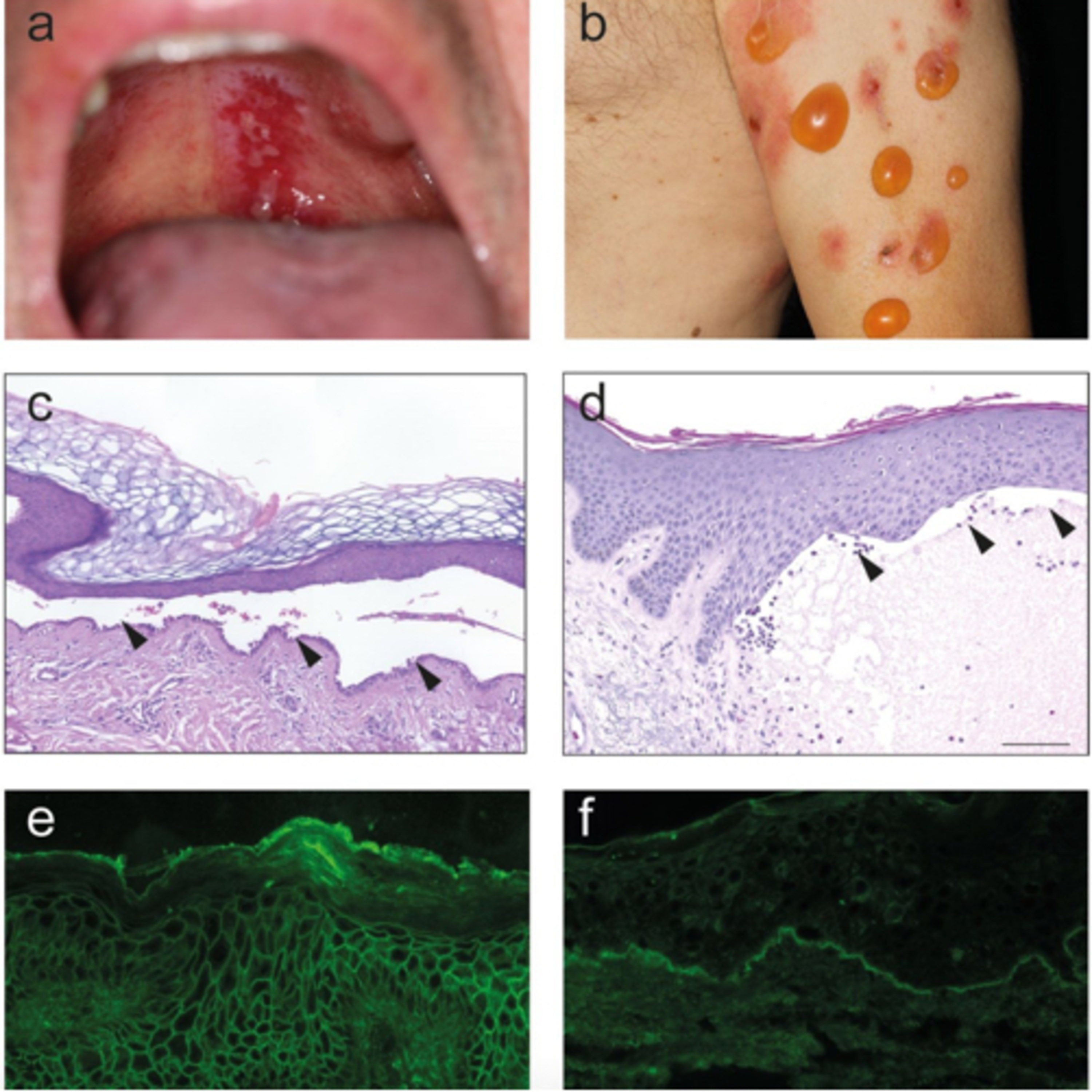 “What are Key Differences Between Pemphigus & Pemphigoid?” episode artwork