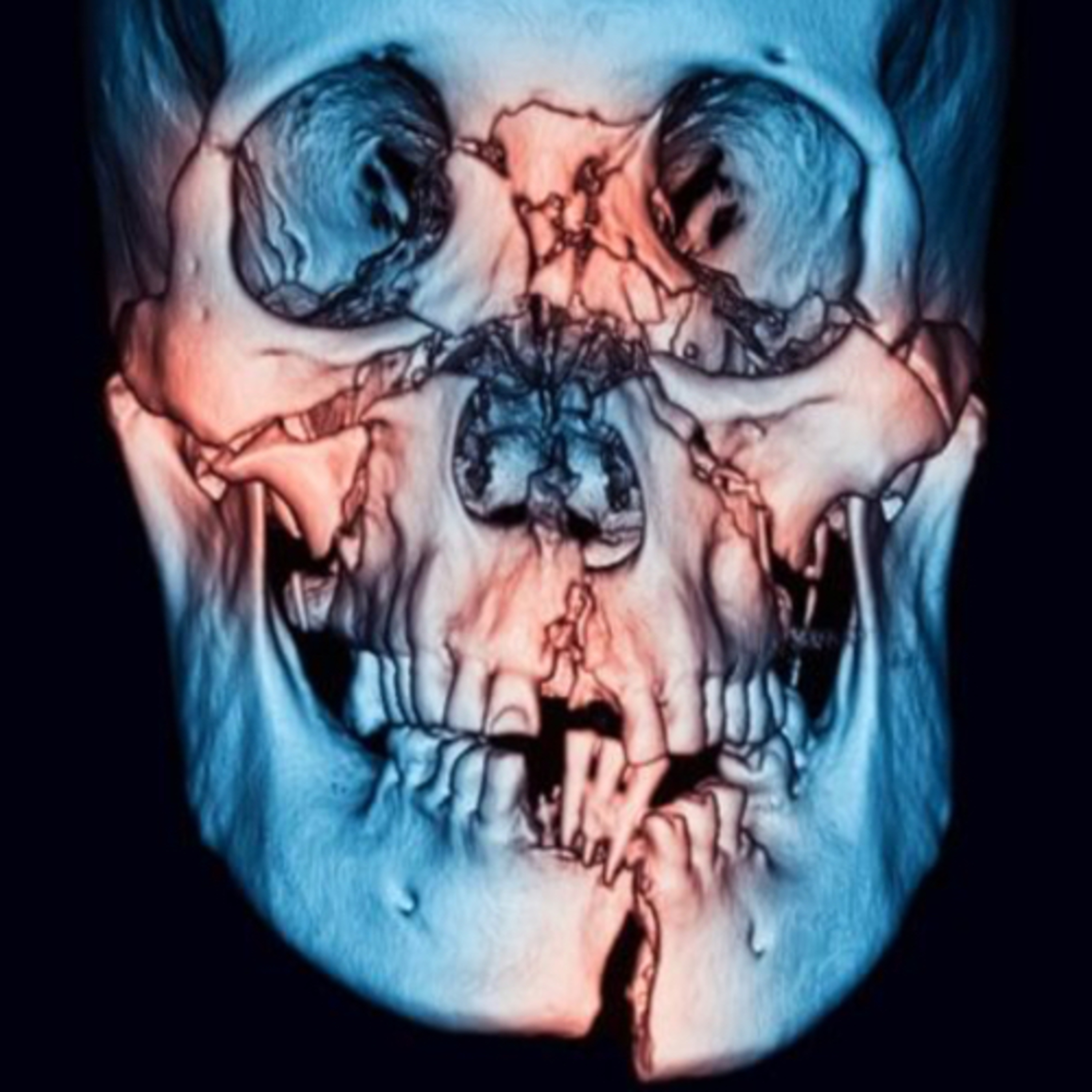 “What Is the Relationship Between Maxillofacial Injury Location and Associated Injuries?”  episode artwork