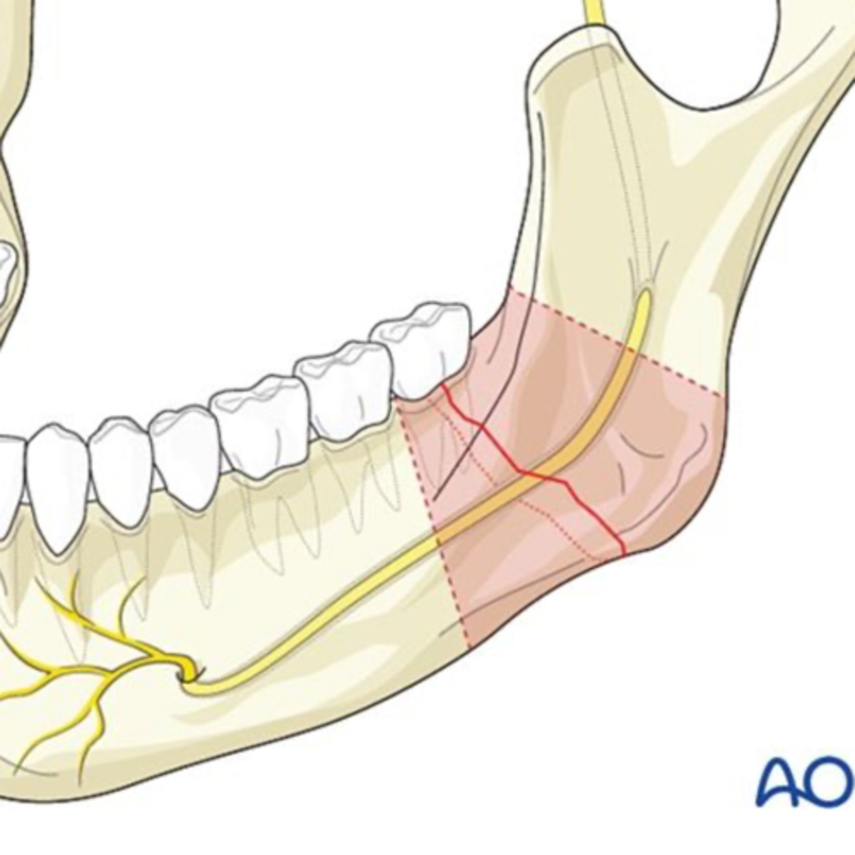 “What is the Incidence of Paresthesia after Mandible Fractures of Different Patterns?” episode artwork