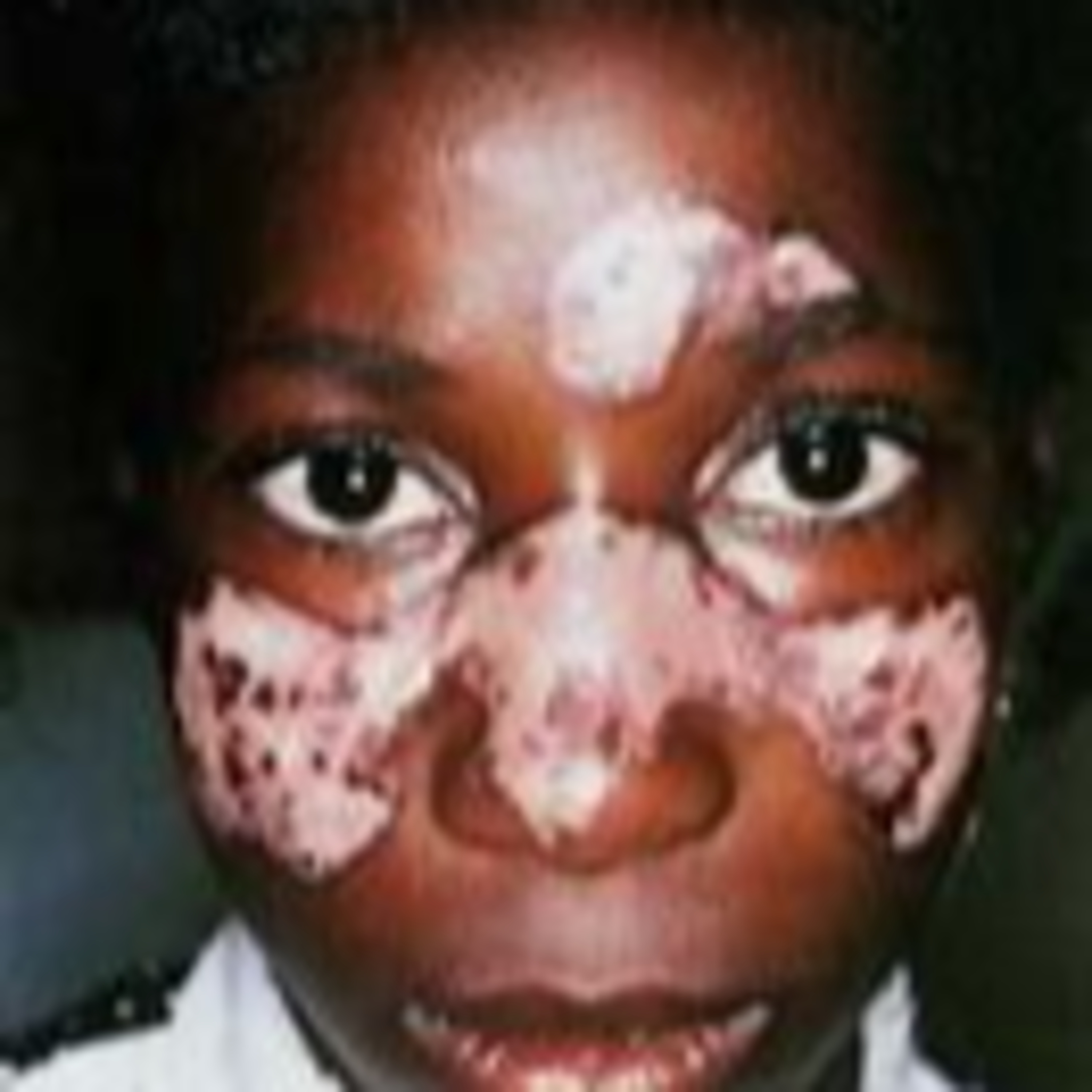 More Than 200,000 Americans Have Lupus