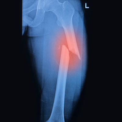 Compartment Syndrome 