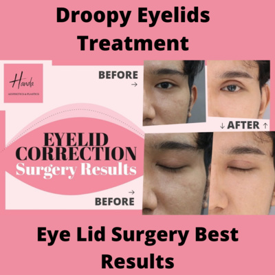 Droopy Eyelids Treatment - Best Results