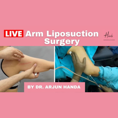 Arm Liposuction - LIVE Surgery| Dr. Arjun Handa| Arm Lift Surgery at Handa Aesthetics