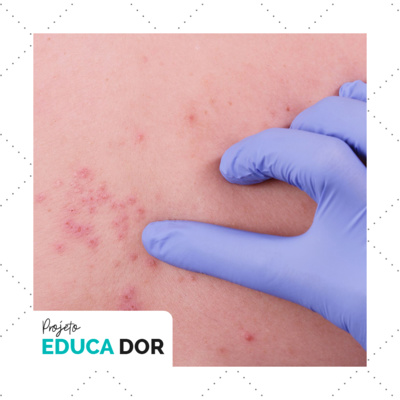 #24 - A infecção pelo Herpes Zoster