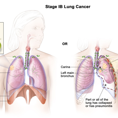 FDA grants accelerated approval to mobocertinib for metastatic non-small cell lung cancer with EGFR exon 20 insertion mutations