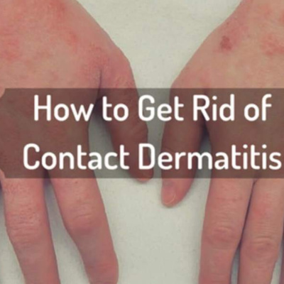 How To Treat and Prevent Contact Dermatitis