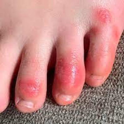 Covid toes: A perplexing medical finding in Covid 19 Covid toes: A perplexing medical finding in Covid 19
