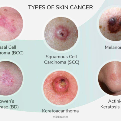 Skin Cancer and What It Looks Like
