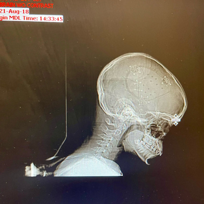 The Space Between - Epidural Hemorrhage Journey 