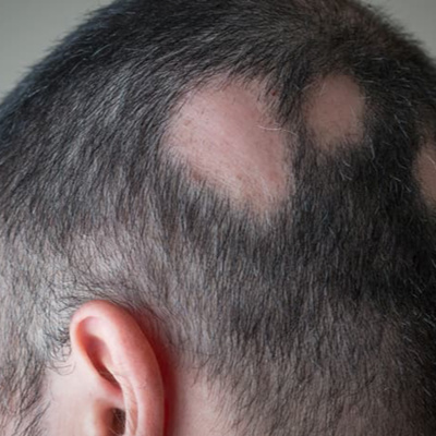 27才男性 "円形脱毛症/自信がなくなっていく/人と会えない/恋愛できない" 27才男性 "円形脱毛症/自信がなくなっていく/人と会えない/恋愛できない"