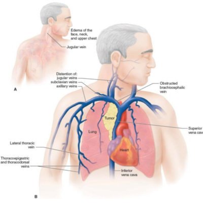 Síndrome de vena cava superior - primera parte