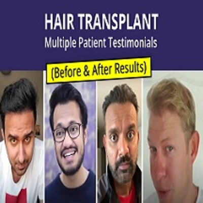 Hair Transplant - Patient Reviews | Medlinks | Before & After Results | Multiple Client Testimonials