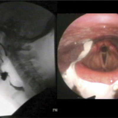 Series on Dysphagia: Episode 1 episode artwork