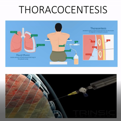 THORACOCENTESIS