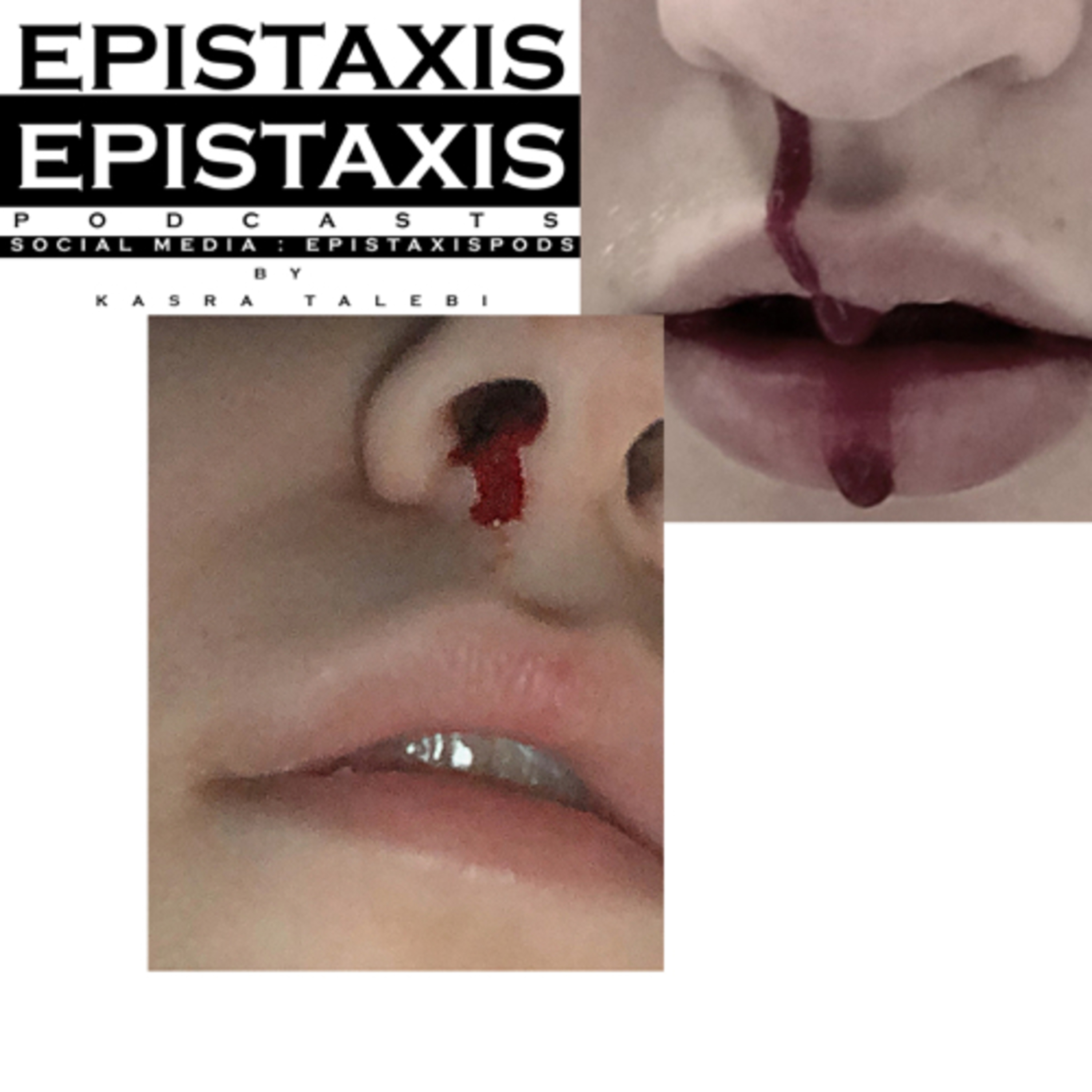 کاور Epistaxis