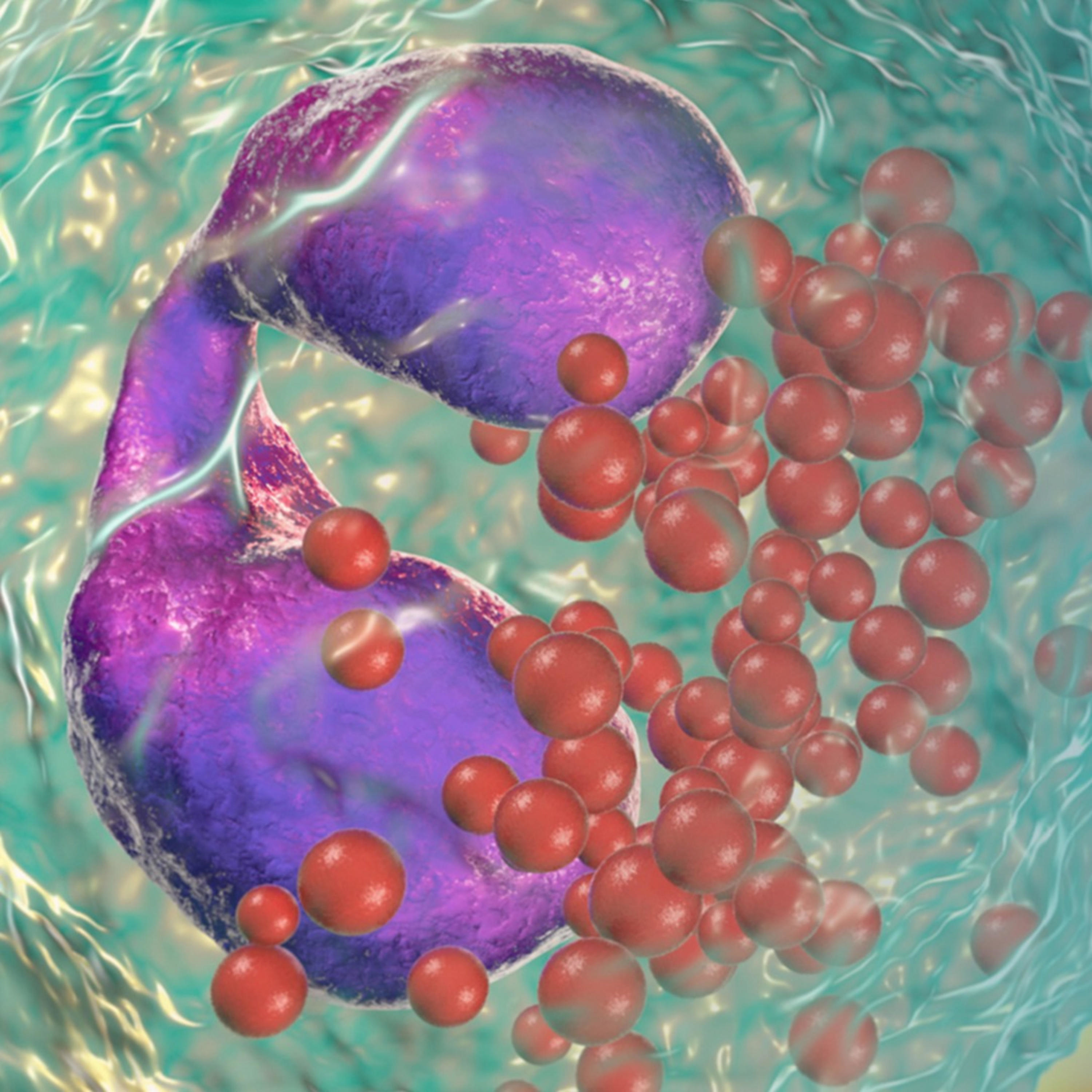 Exploring Best Practices for Diagnosis and Management of Hypereosinophilic Syndrome
