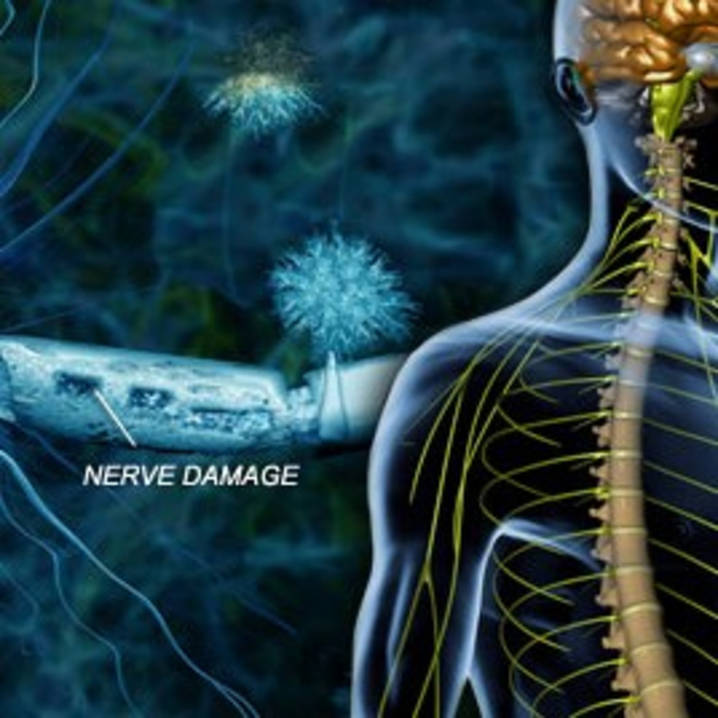 Multiple Sclerosis PSA 