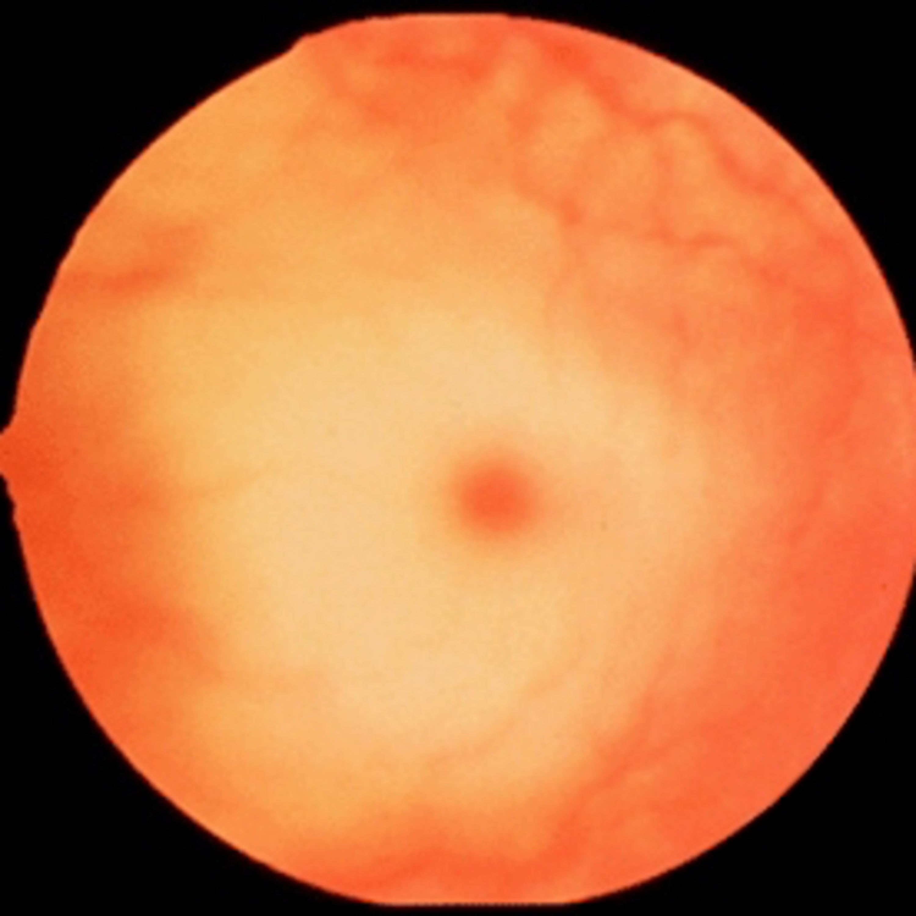 Fast Facts on Tay Sachs