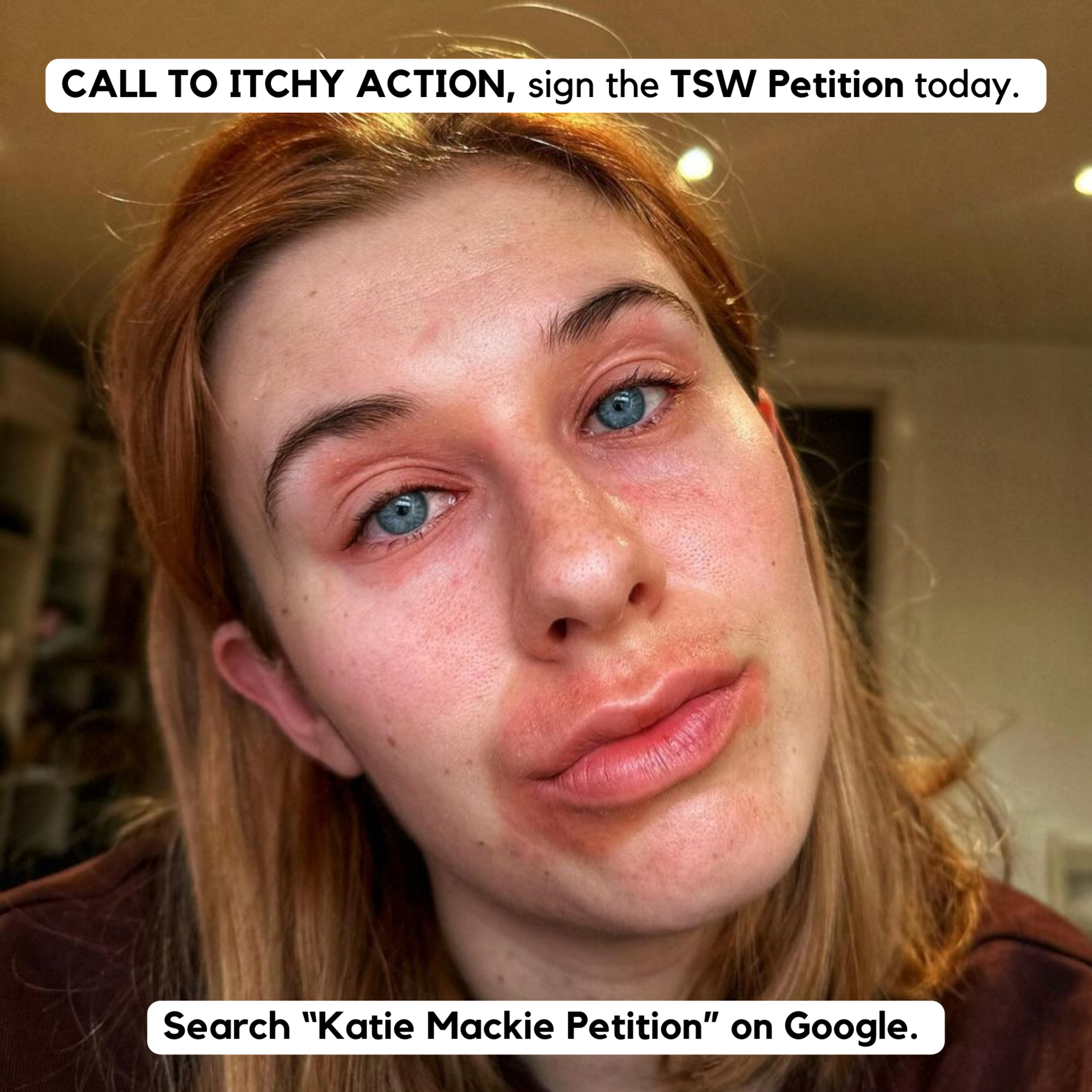 Call to ITCHY ACTION - Fund Topical Steroid Withdrawal (TSW) 