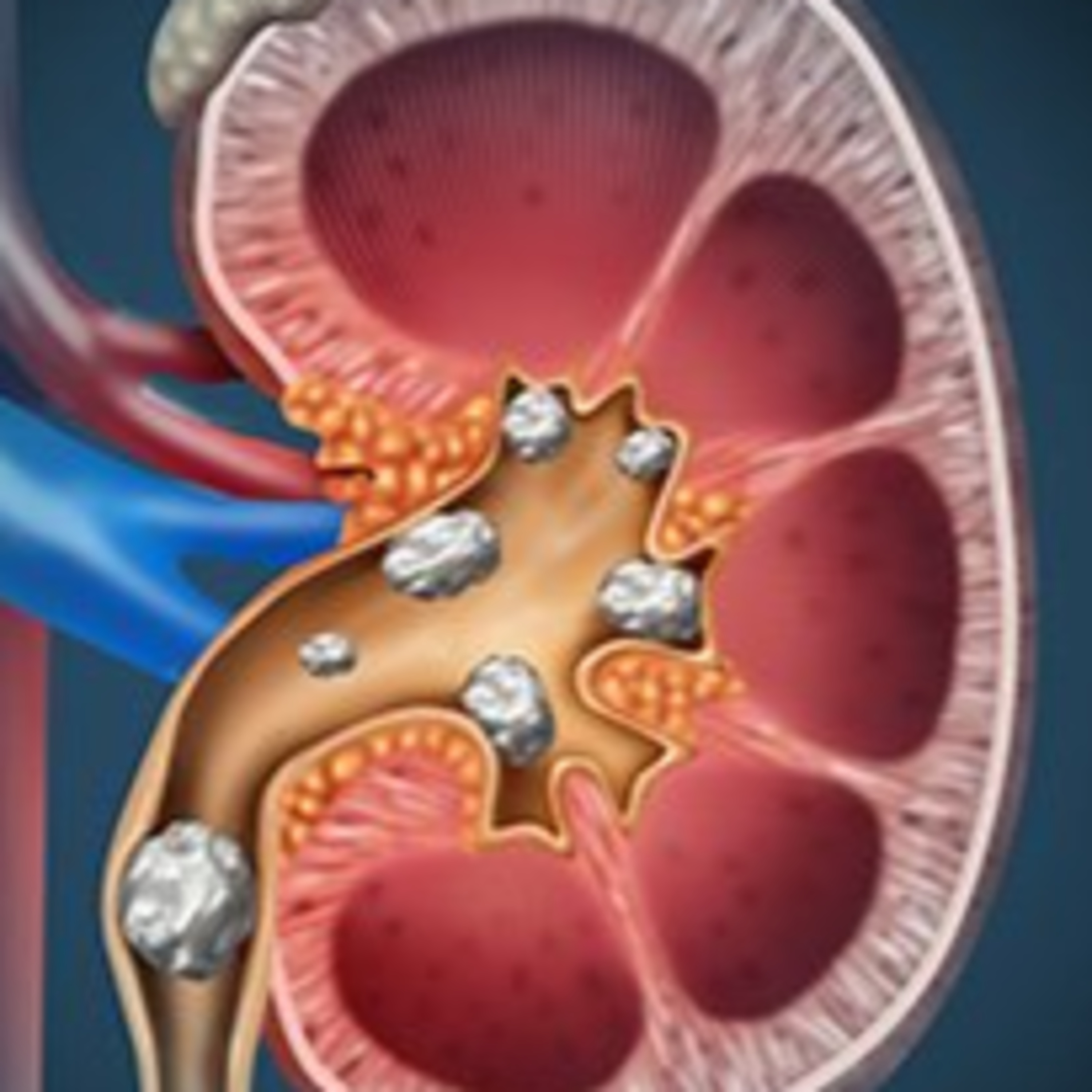 Vitamin C and Kidney Stones, Fact or Fiction?