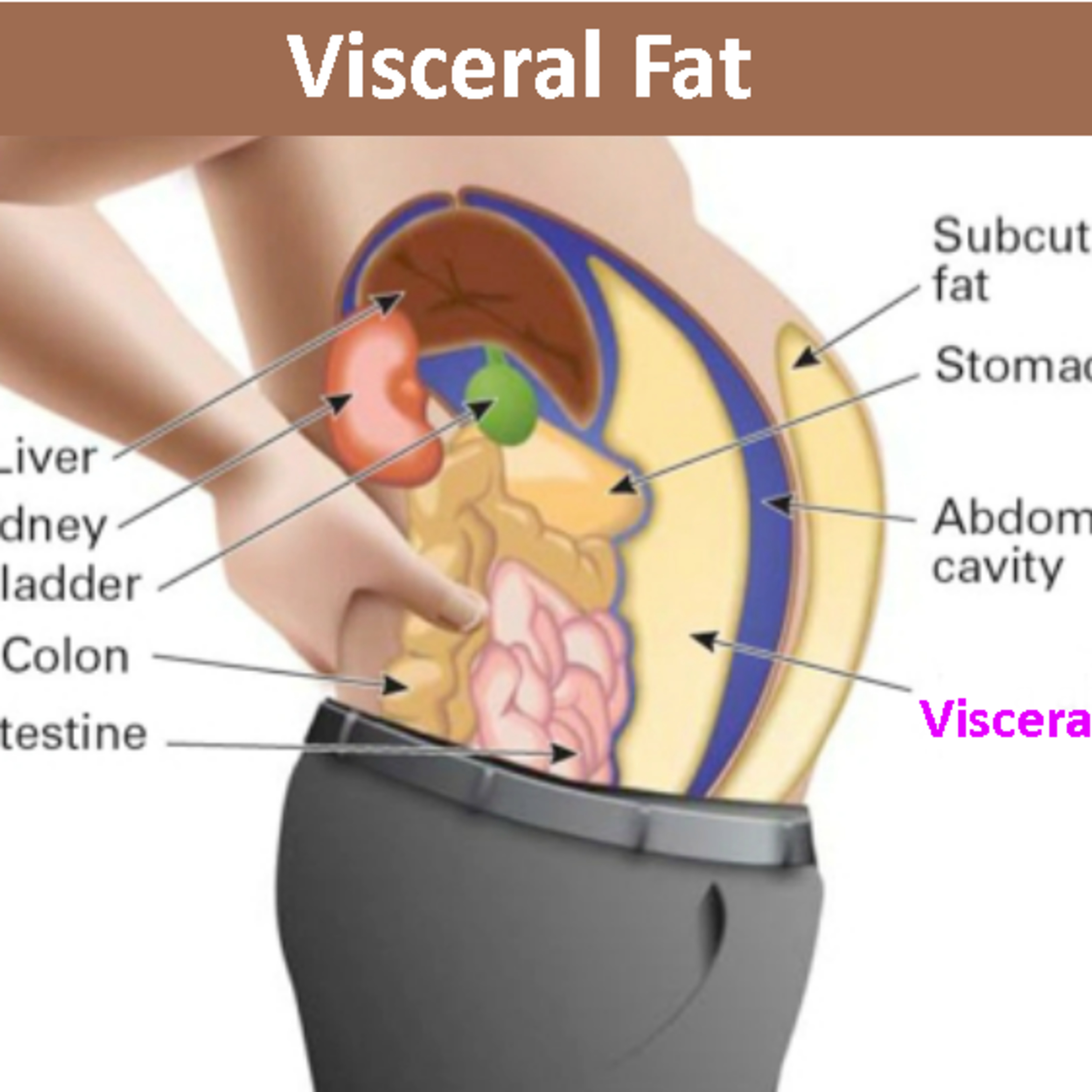 Visceral Fat and BMI Debate and Science behind the change in the American Medical Industry, insurance, health claims, insulin, diabetes, and carbohydrate intolerance. 