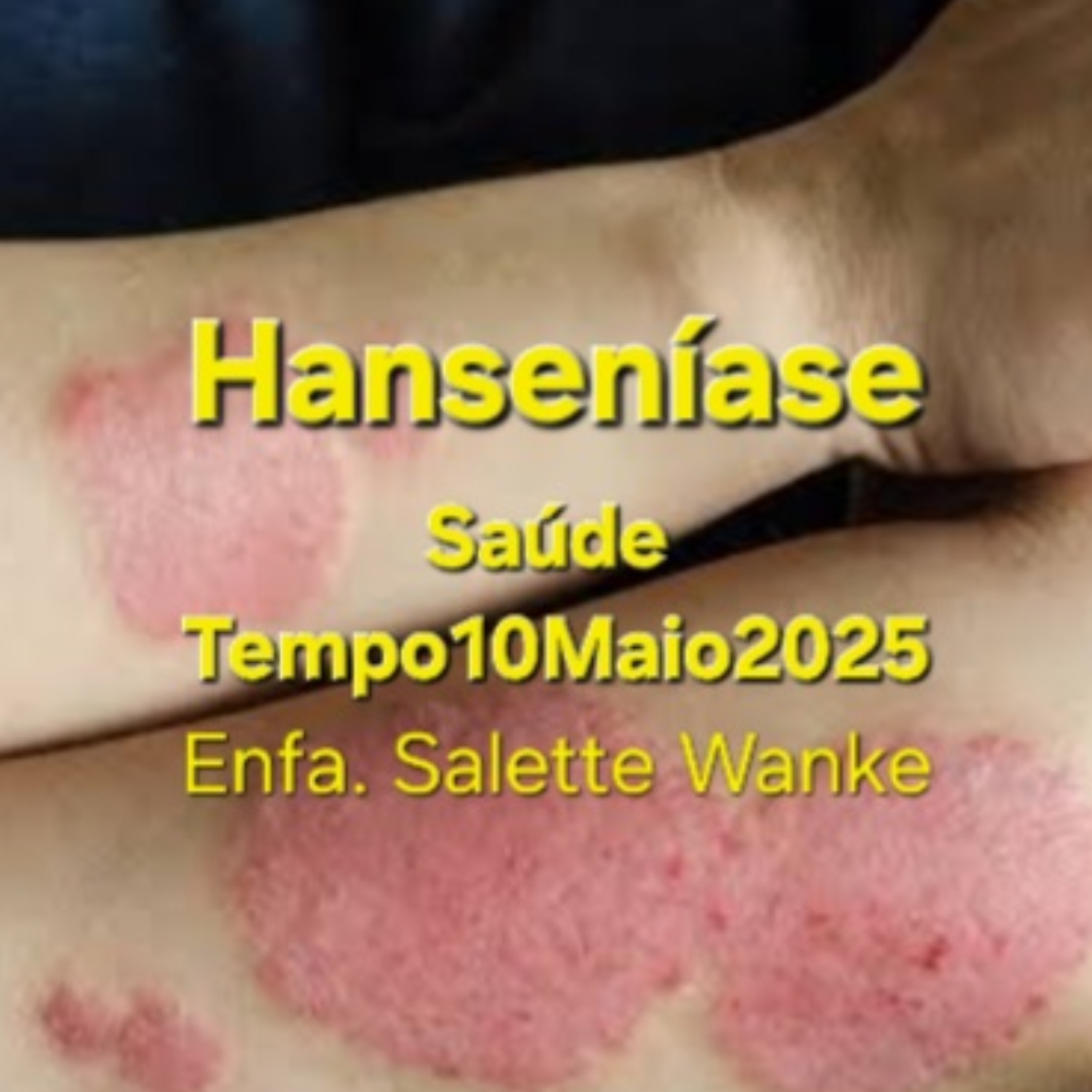 Hanseníase episode artwork