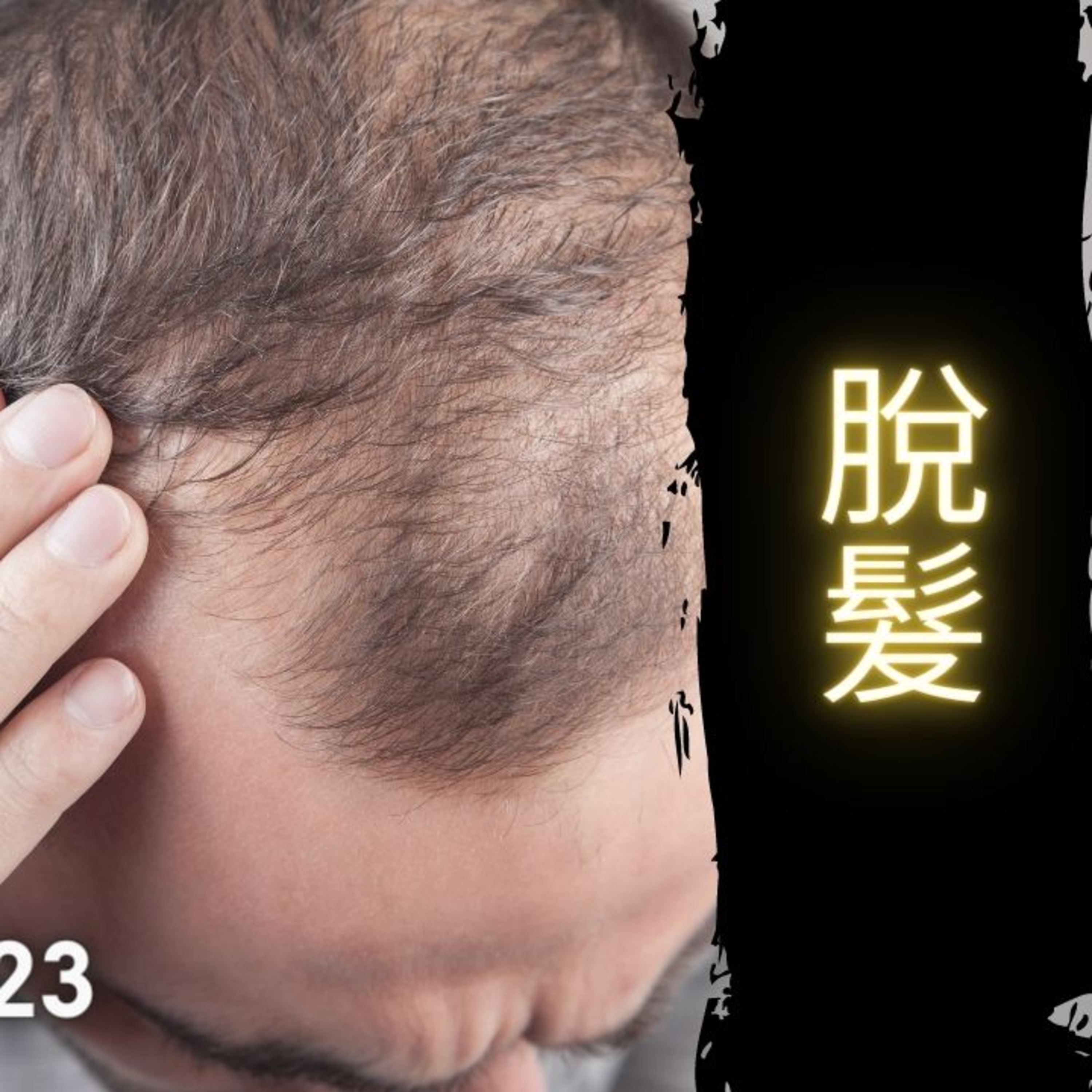 《醫學新世代》脫髮 - 6.18.2023