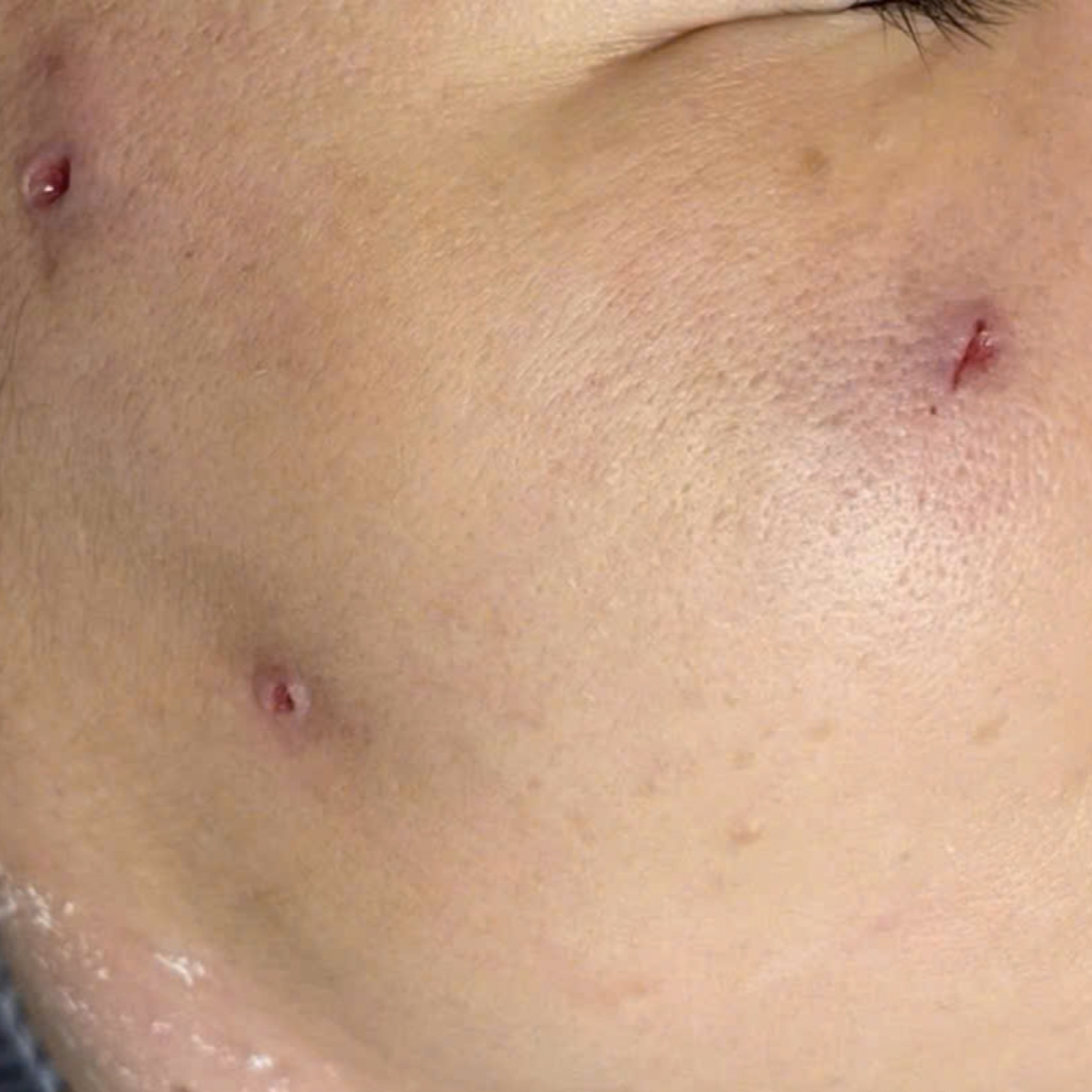 Tiêu điểm - Cảnh báo biến chứng da liễu thẩm mỹ: Làm đẹp an toàn không thể “đánh cược”